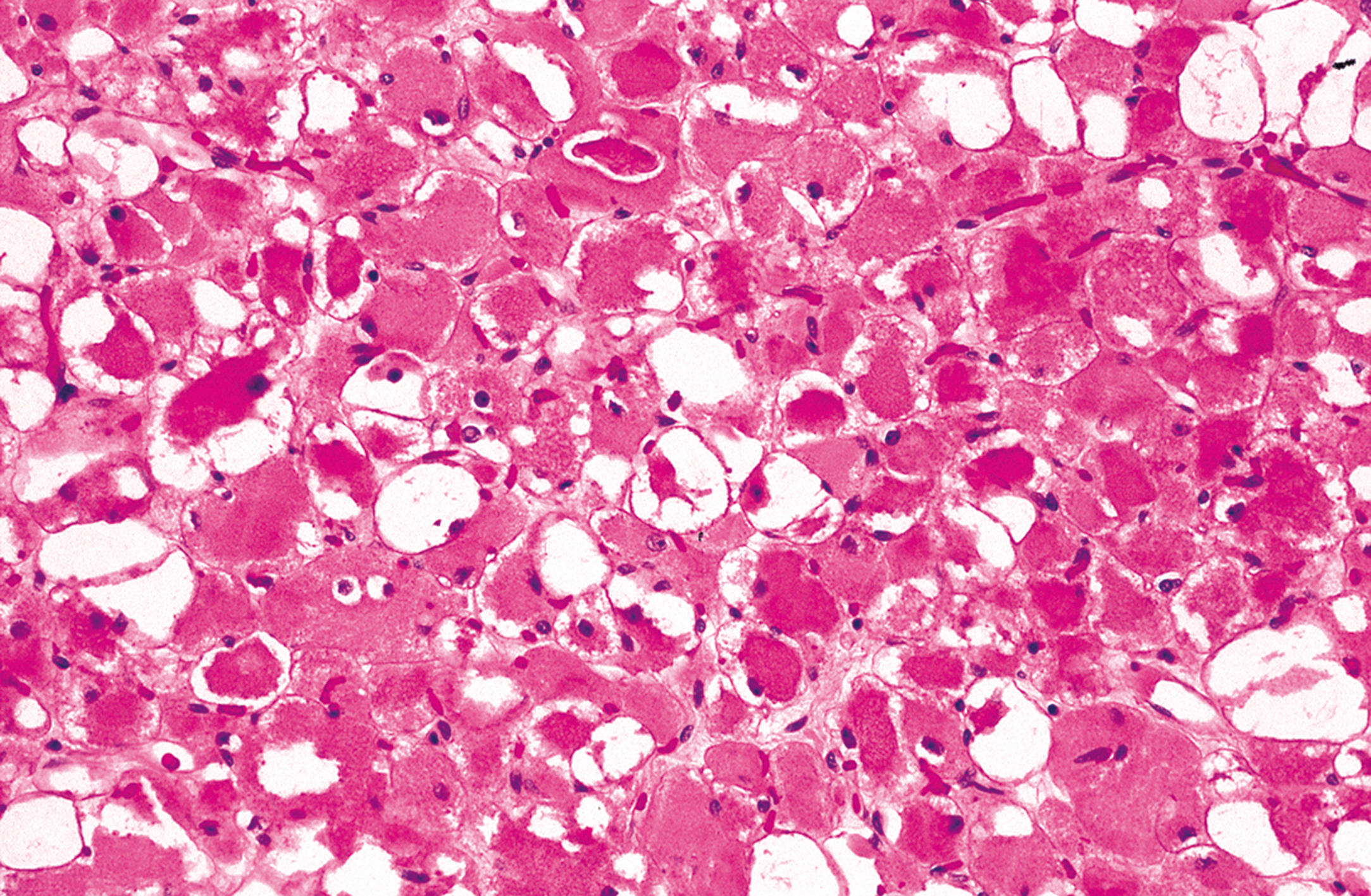 An adult rhabdomyoma with eosinophilic polygonal cells of varying size, showing peripheral nuclei and occasional intracellular vacuoles.