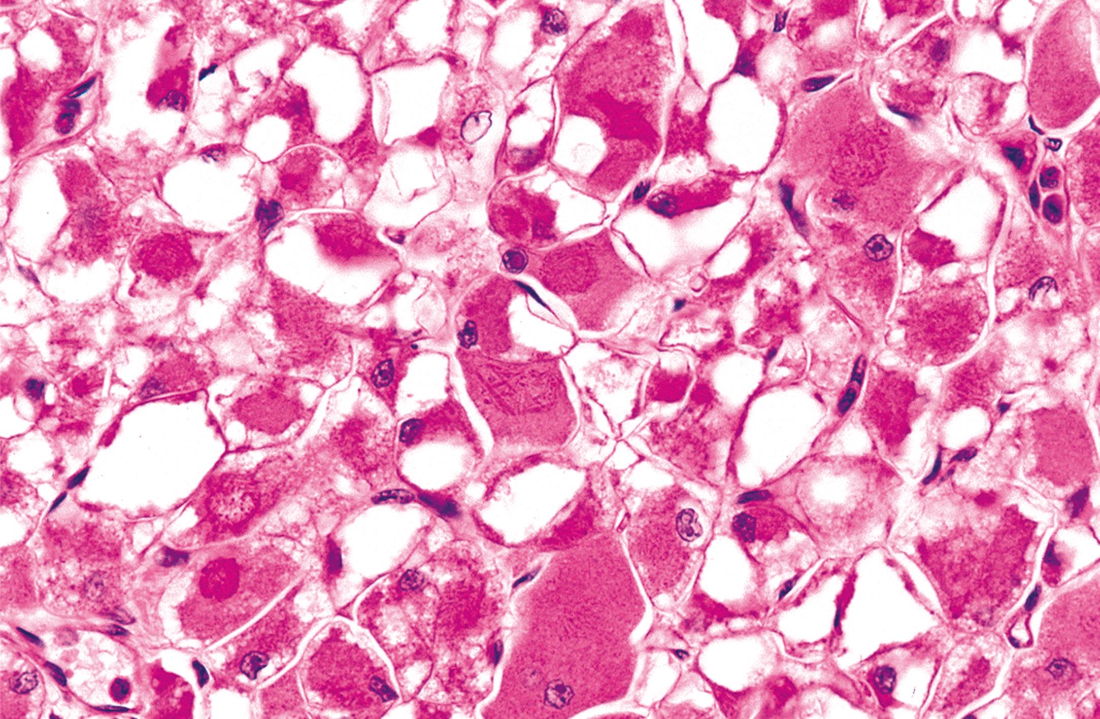 An arrangement of large polygonal cells with visible vacuoles and rare needle-like crystalline inclusions within the cytoplasm.