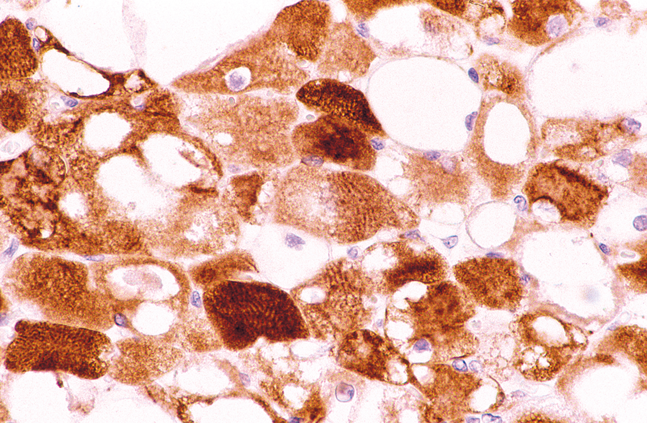 A section of tissue with large polygonal cells exhibiting strong intracellular staining patterns and enhanced linear banding across the cytoplasm.