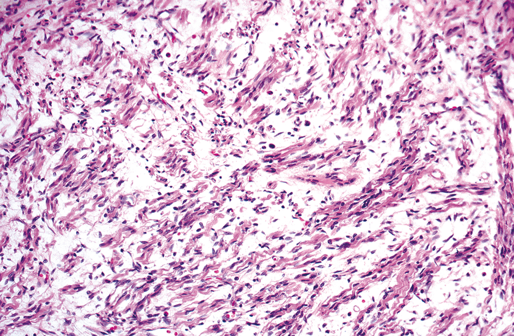 A histological slide of fibrous tissue with elongated cells and scattered nuclei arranged in a parallel, dense pattern.