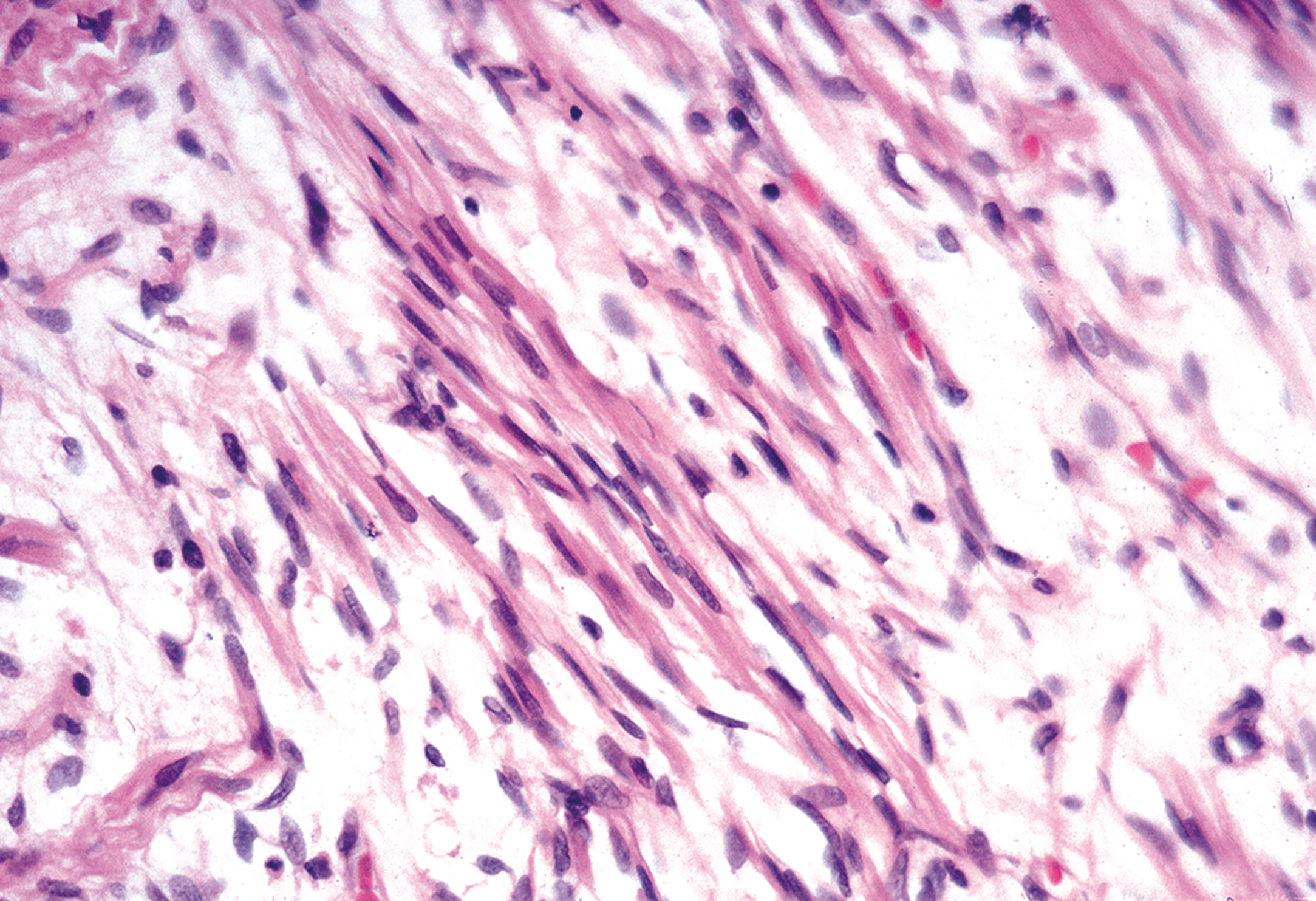 A tissue section showing elongated spindle-shaped cells arranged in interwoven bundles with scattered nuclei.