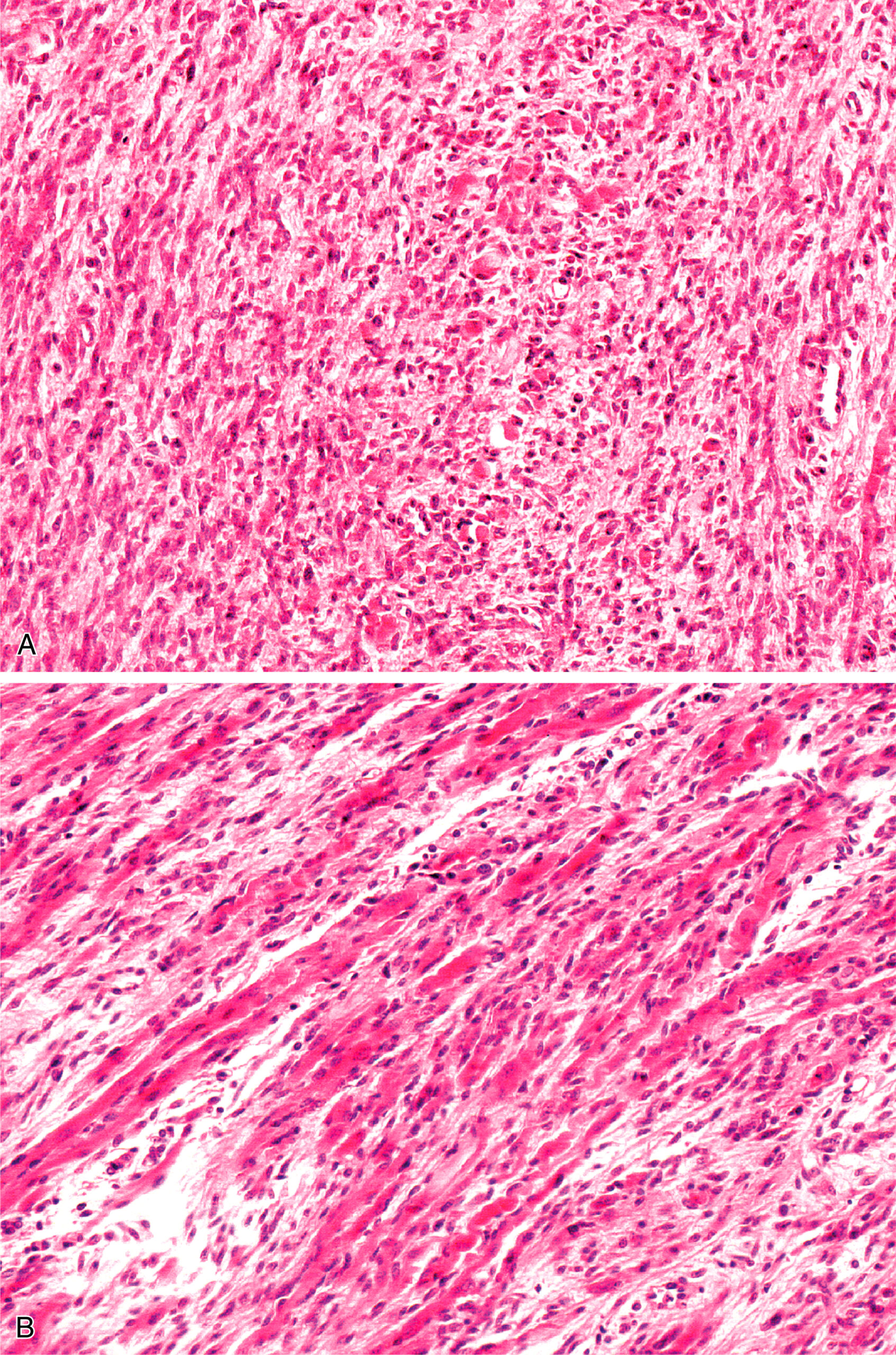 A set of three microscopic views of tissue: the first with a dense cellular pattern, the second with aligned fibrous structures, and the third showing a high-magnification view of the second. The microscopic view presents two distinct tissue sections labeled A, B, and C. Section A displays a dense and irregular cellular pattern. The cells are tightly packed with no clear organization, and they appear as a mass of small, rounded structures. Section B reveals aligned fibrous structures. The fibers are elongated and arranged in parallel, which creates a striated texture. The cells within the fibers are elongated and oriented along the fiber direction. Both sections exhibit a similar stain pattern, which highlights the cellular and fibrous components. Section C shows an enlarged version of the aligned fibrous structures in section B, highlighting the centrally located nuclei in the cells.