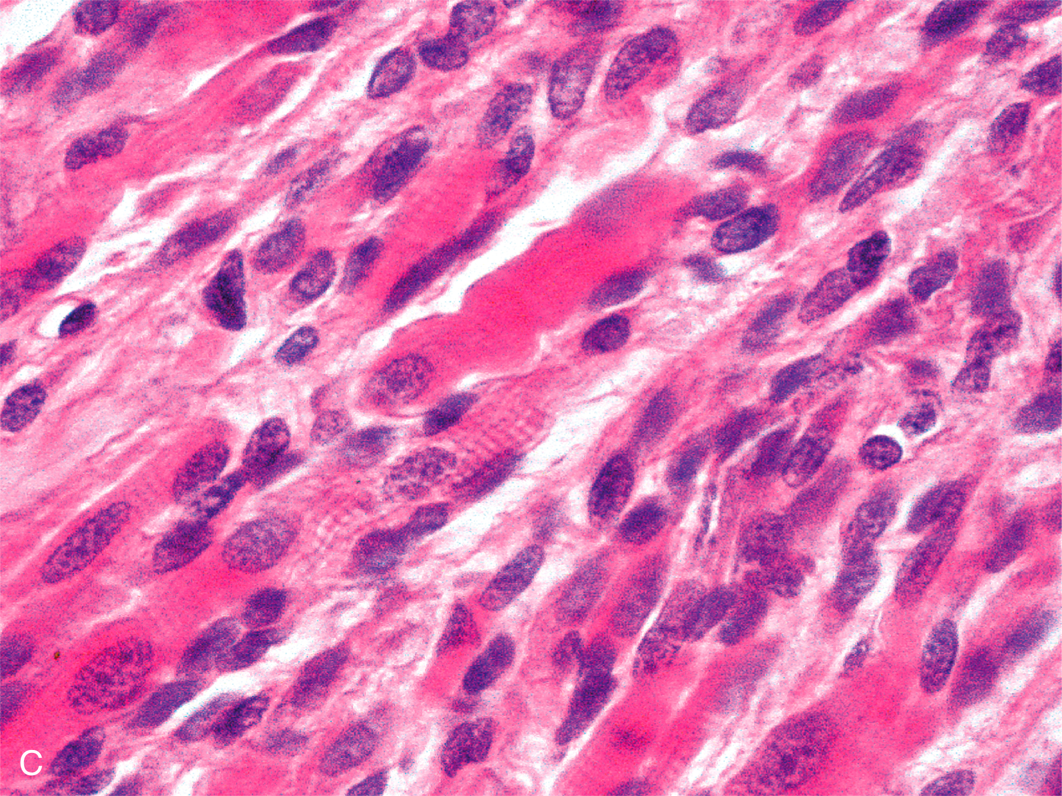A set of three microscopic views of tissue: the first with a dense cellular pattern, the second with aligned fibrous structures, and the third showing a high-magnification view of the second. The microscopic view presents two distinct tissue sections labeled A, B, and C. Section A displays a dense and irregular cellular pattern. The cells are tightly packed with no clear organization, and they appear as a mass of small, rounded structures. Section B reveals aligned fibrous structures. The fibers are elongated and arranged in parallel, which creates a striated texture. The cells within the fibers are elongated and oriented along the fiber direction. Both sections exhibit a similar stain pattern, which highlights the cellular and fibrous components. Section C shows an enlarged version of the aligned fibrous structures in section B, highlighting the centrally located nuclei in the cells.