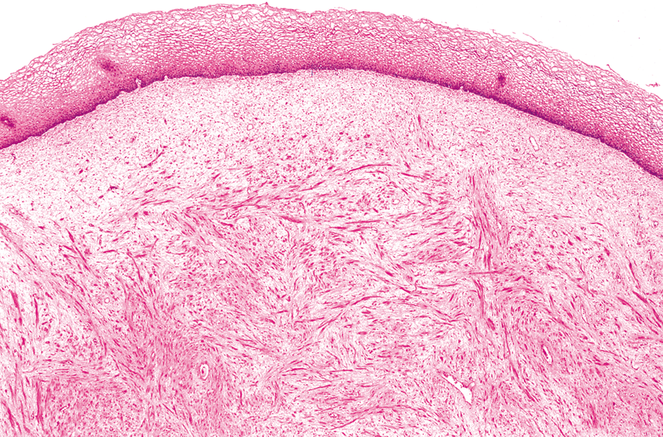 A histological section showing submucosal proliferation of striated muscle cells separated by myxoid material and collagen.