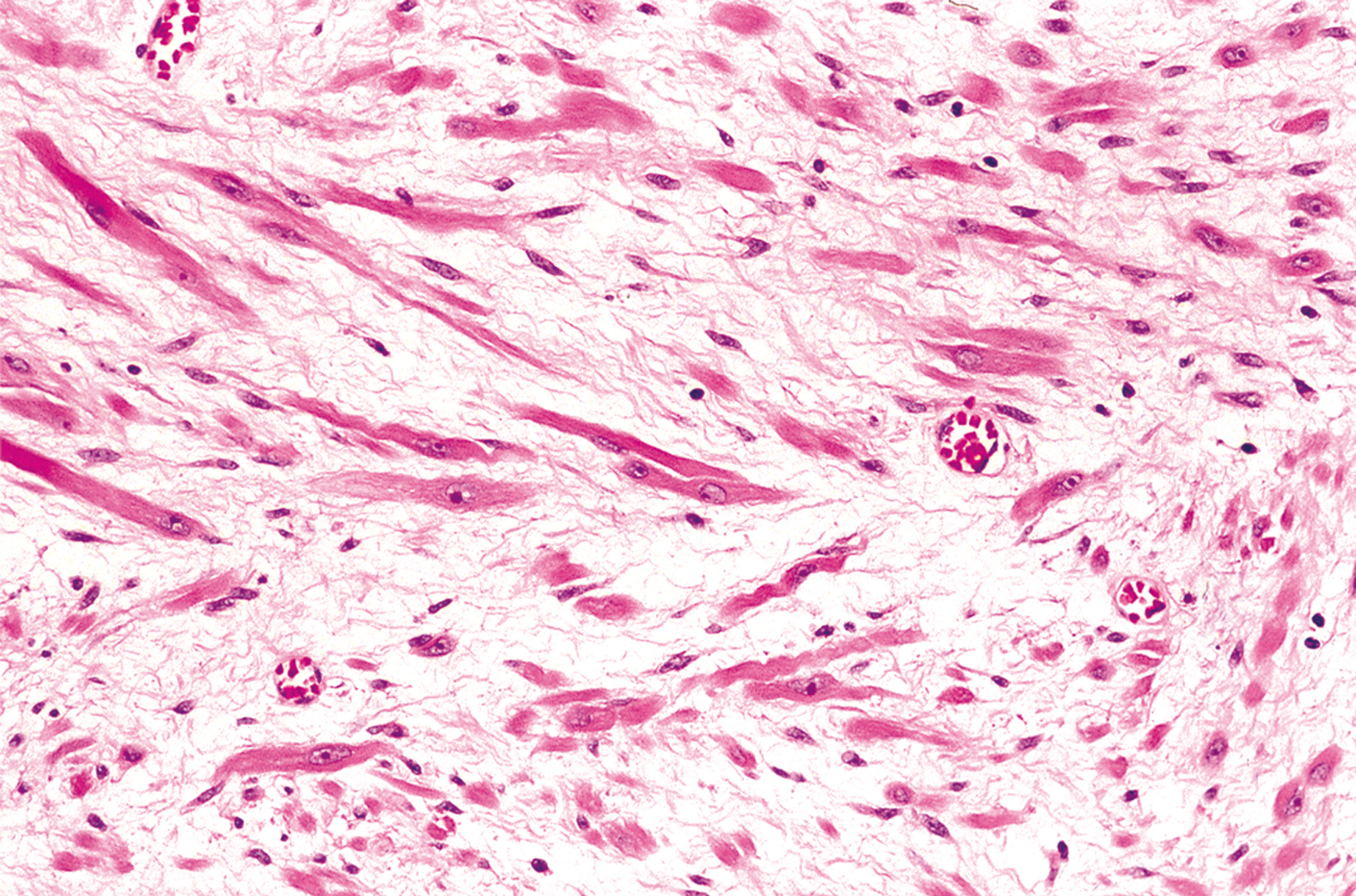 A histological section showing bundles of striated muscle cells with occasional large round structures, separated by collagen fibers.