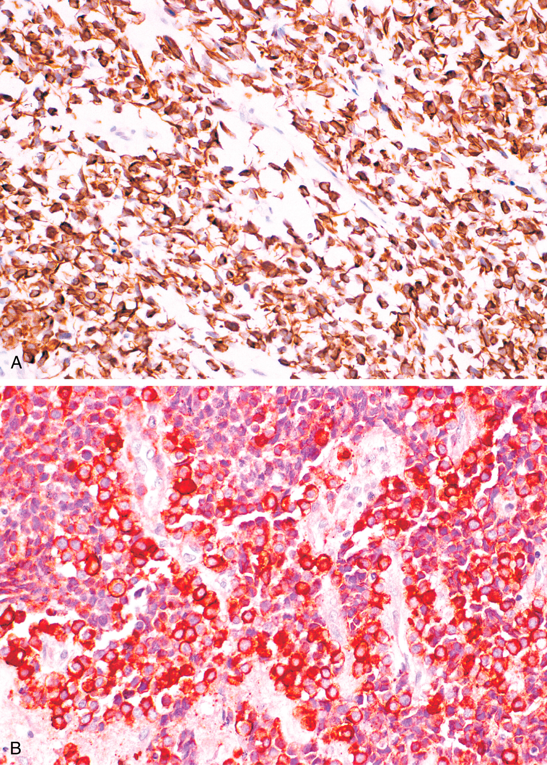 A dual-panel view showing strong desmin staining in both embryonal and alveolar rhabdomyosarcoma, contrasting with patchy myogenin expression. The histological comparison of embryonal rhabdomyosarcoma and alveolar rhabdomyosarcoma shows diffuse and strong immunoreactivity for desmin in both tumor types. Panel A shows abundant desmin expression in embryonal rhabdomyosarcoma, while panel B displays a similar pattern in alveolar rhabdomyosarcoma. In contrast, embryonal rhabdomyosarcoma typically exhibits only patchy expression of myogenin, highlighting differences in protein expression patterns between the two tumor subtypes.