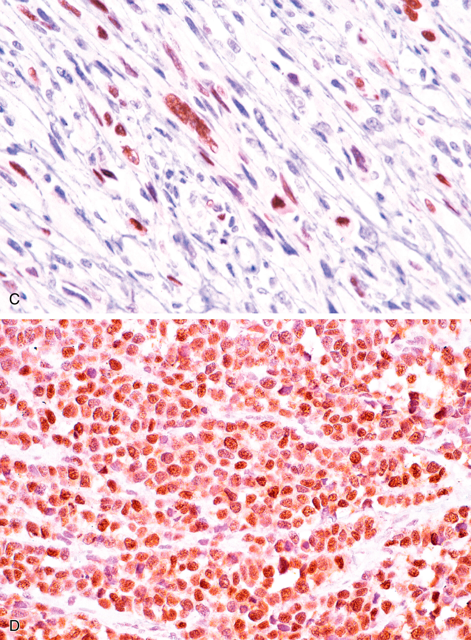 A dual-panel view showing strong desmin staining in both embryonal and alveolar rhabdomyosarcoma, contrasting with patchy myogenin expression. The histological comparison of embryonal rhabdomyosarcoma and alveolar rhabdomyosarcoma shows diffuse and strong immunoreactivity for desmin in both tumor types. Panel A shows abundant desmin expression in embryonal rhabdomyosarcoma, while panel B displays a similar pattern in alveolar rhabdomyosarcoma. In contrast, embryonal rhabdomyosarcoma typically exhibits only patchy expression of myogenin, highlighting differences in protein expression patterns between the two tumor subtypes.