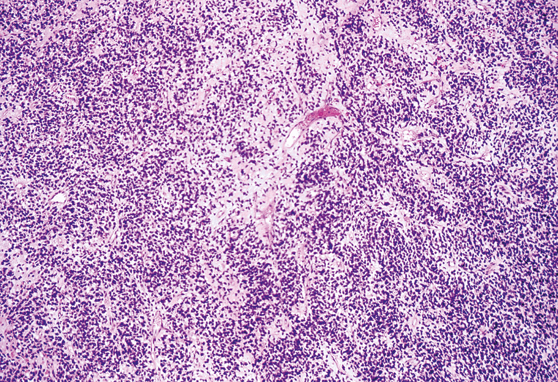 A low-power view showing alternating cellular and myxoid areas, a characteristic pattern in embryonal rhabdomyosarcoma.