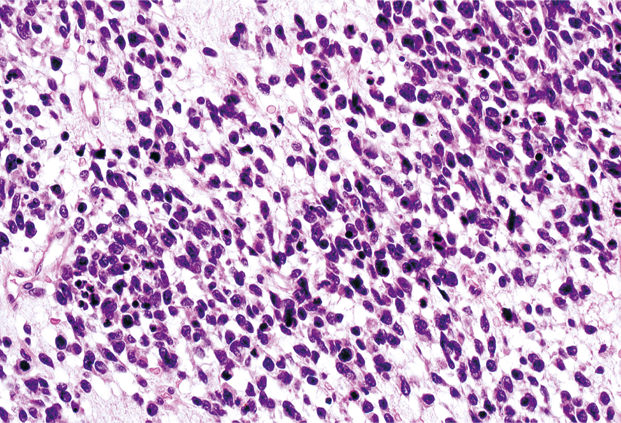 A section showing alternating dense cellular areas and myxoid regions, typical of embryonal rhabdomyosarcoma.
