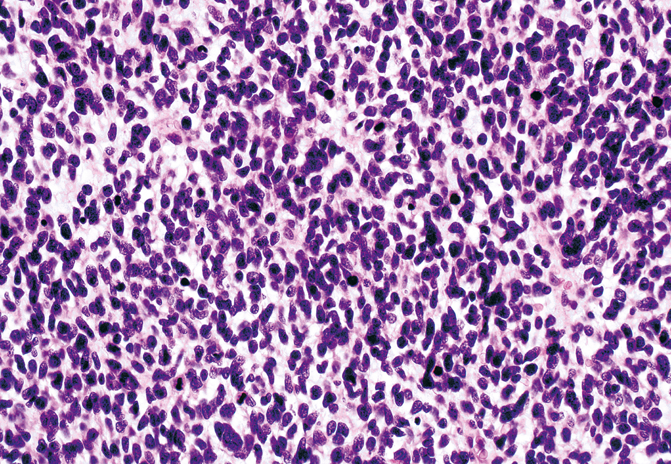 A high-power view showing embryonal rhabdomyosarcoma composed mainly of primitive ovoid cells, with densely packed round to oval nuclei.