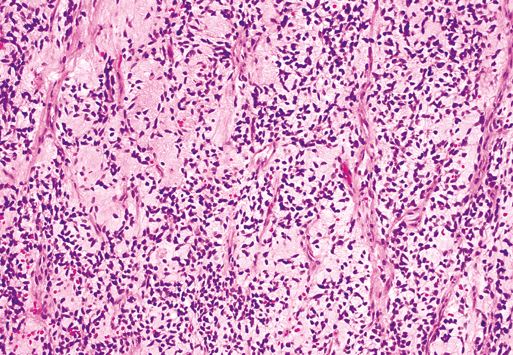 A section showing primitive spindle-shaped cells embedded in abundant myxoid stroma, characteristic of embryonal rhabdomyosarcoma.