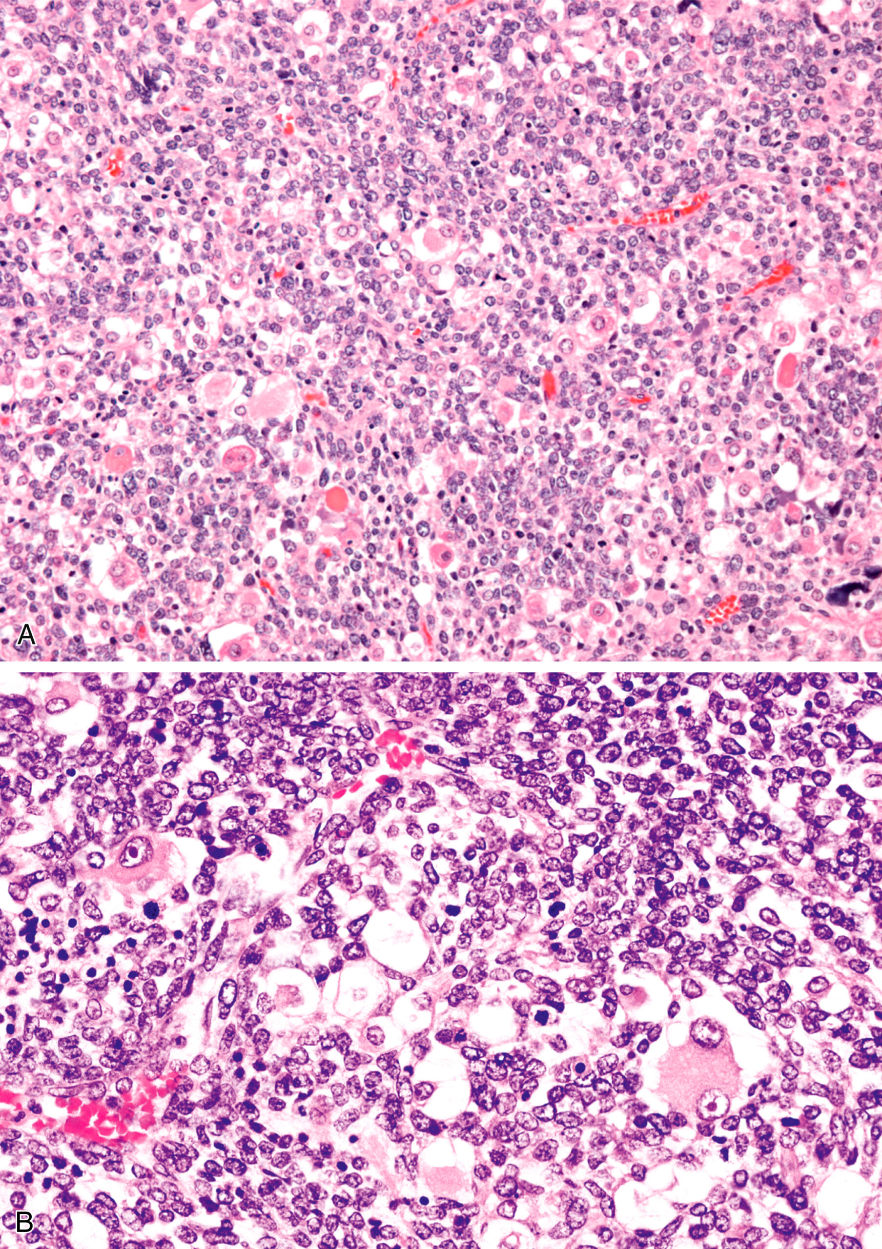 A section showing embryonal rhabdomyosarcoma with primitive round cells in the upper panel and more mature rhabdomyoblasts in the lower panel. The two-part histological image depicting embryonal rhabdomyosarcoma. Panel A shows the tumor predominantly composed of primitive round cells, a hallmark feature of early-stage rhabdomyosarcoma. Panel B provides a high-power view showing more mature rhabdomyoblasts with characteristics like vesicular nuclei and prominent nucleoli, indicating progression to a more differentiated stage of the tumor. This contrast highlights the cellular maturation within the tumor.