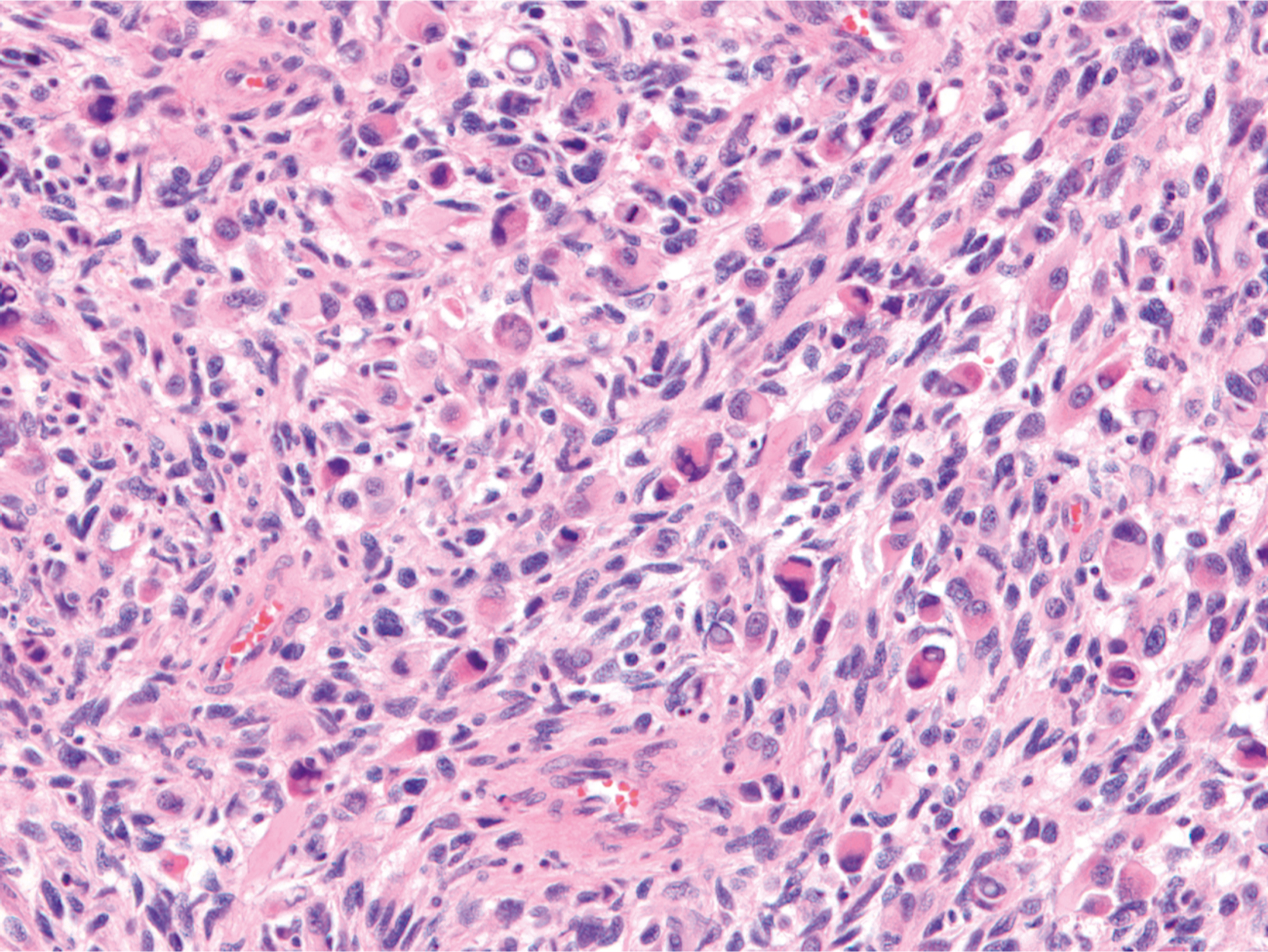 A section showing larger rounded and spindle-shaped cells in embryonal rhabdomyosarcoma, characteristic of this tumor subtype.