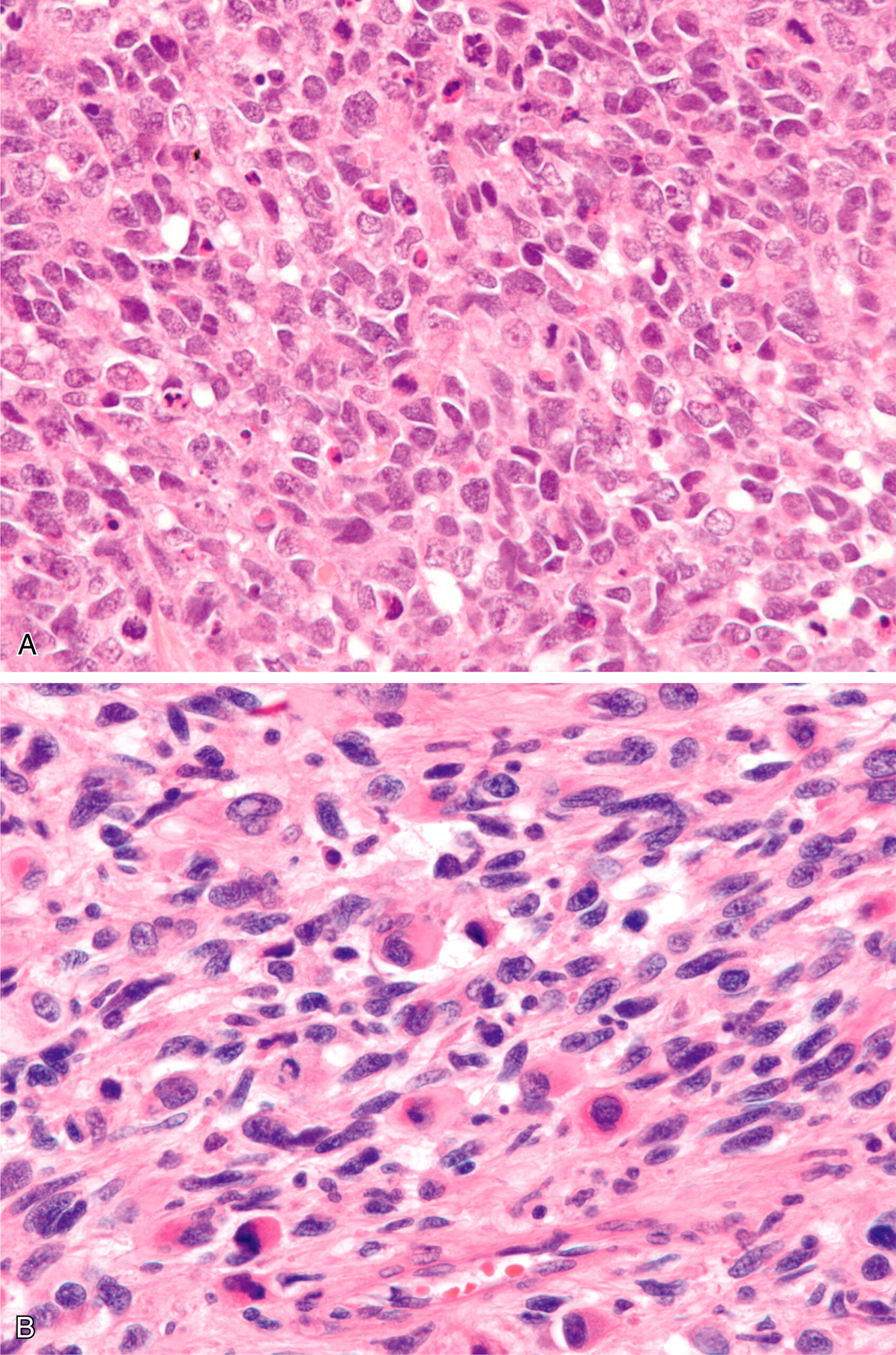 A section showing embryonal rhabdomyosarcoma with larger cells in the upper panel, and spindled cells in the lower panel. The histological comparison shows embryonal rhabdomyosarcoma composed of larger cells in the upper panel, with characteristics such as prominent nuclei and cytoplasm. The lower panel reveals cells that vary in shape, including spindled cells, highlighting the heterogeneous nature of this tumor. The variation in cell size and morphology provides insight into the tumor's developmental stages and cellular differentiation.