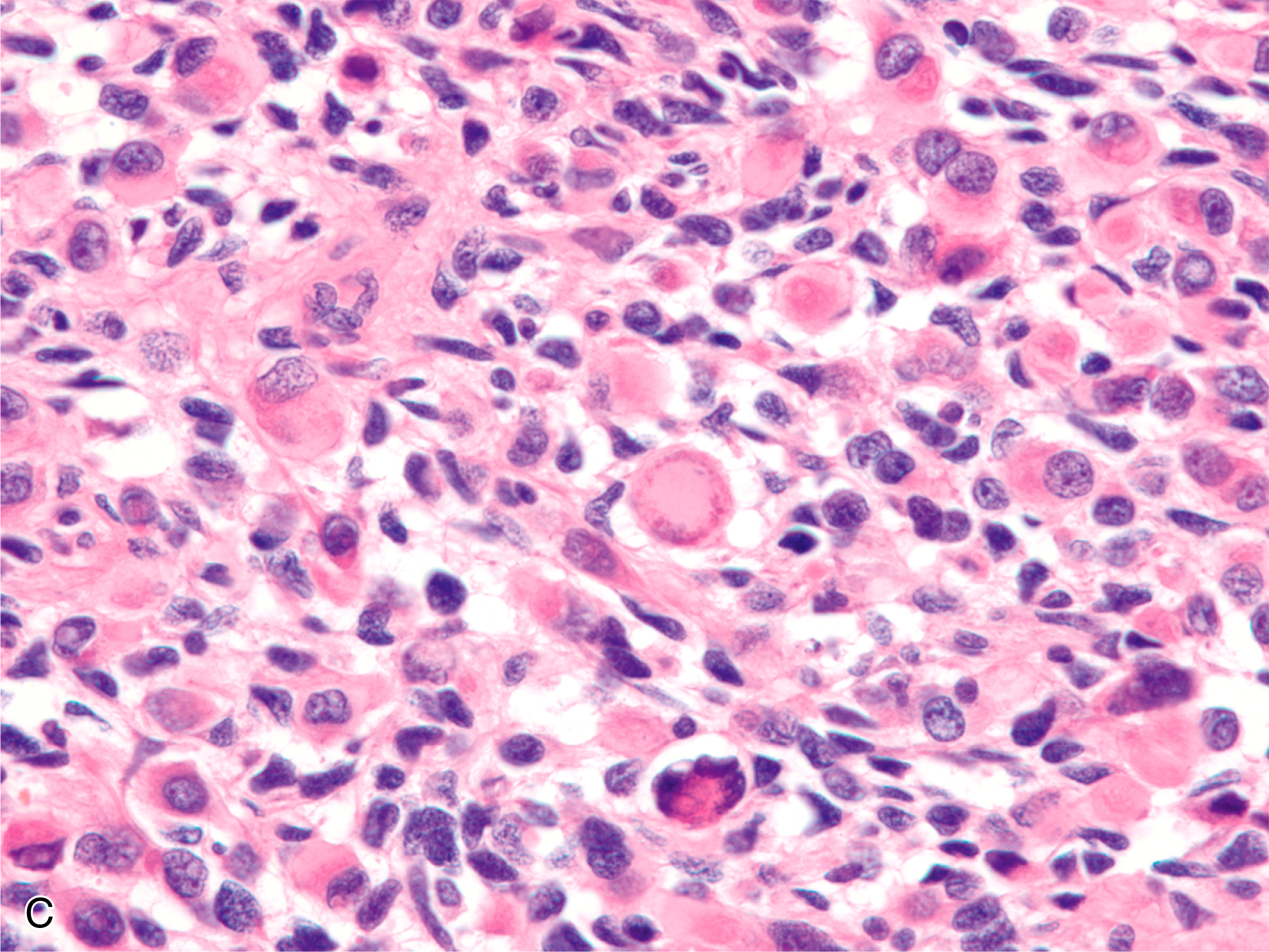 A section showing embryonal rhabdomyosarcoma with larger cells in the upper panel, and spindled cells in the lower panel. The histological comparison shows embryonal rhabdomyosarcoma composed of larger cells in the upper panel, with characteristics such as prominent nuclei and cytoplasm. The lower panel reveals cells that vary in shape, including spindled cells, highlighting the heterogeneous nature of this tumor. The variation in cell size and morphology provides insight into the tumor's developmental stages and cellular differentiation.