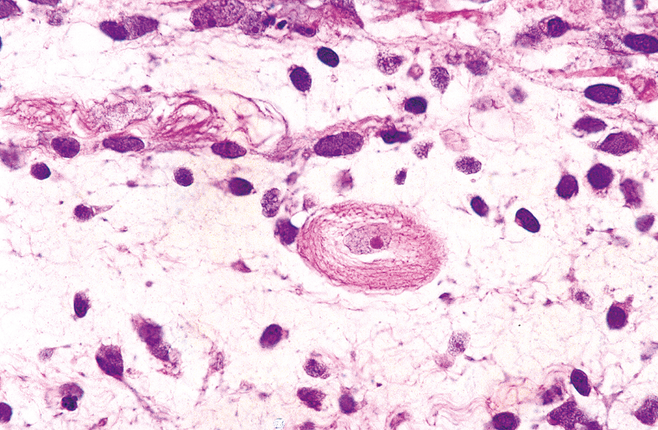 A high-power view showing characteristic rhabdomyoblasts with deeply eosinophilic fibrillar material concentrically arranged around the nucleus.