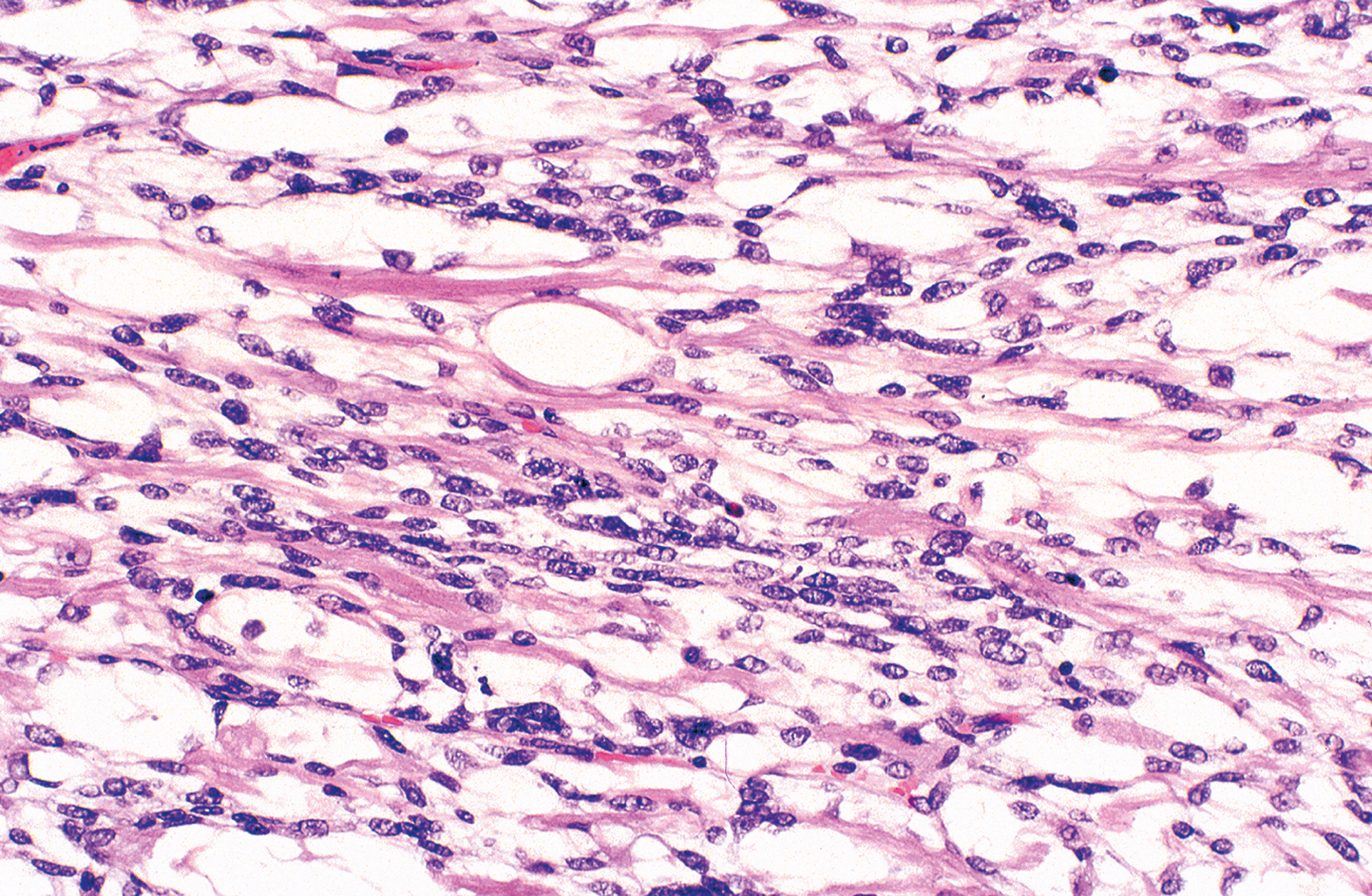 A section showing embryonal rhabdomyosarcoma with atypical spindle-shaped cells and scattered elongated rhabdomyoblasts.