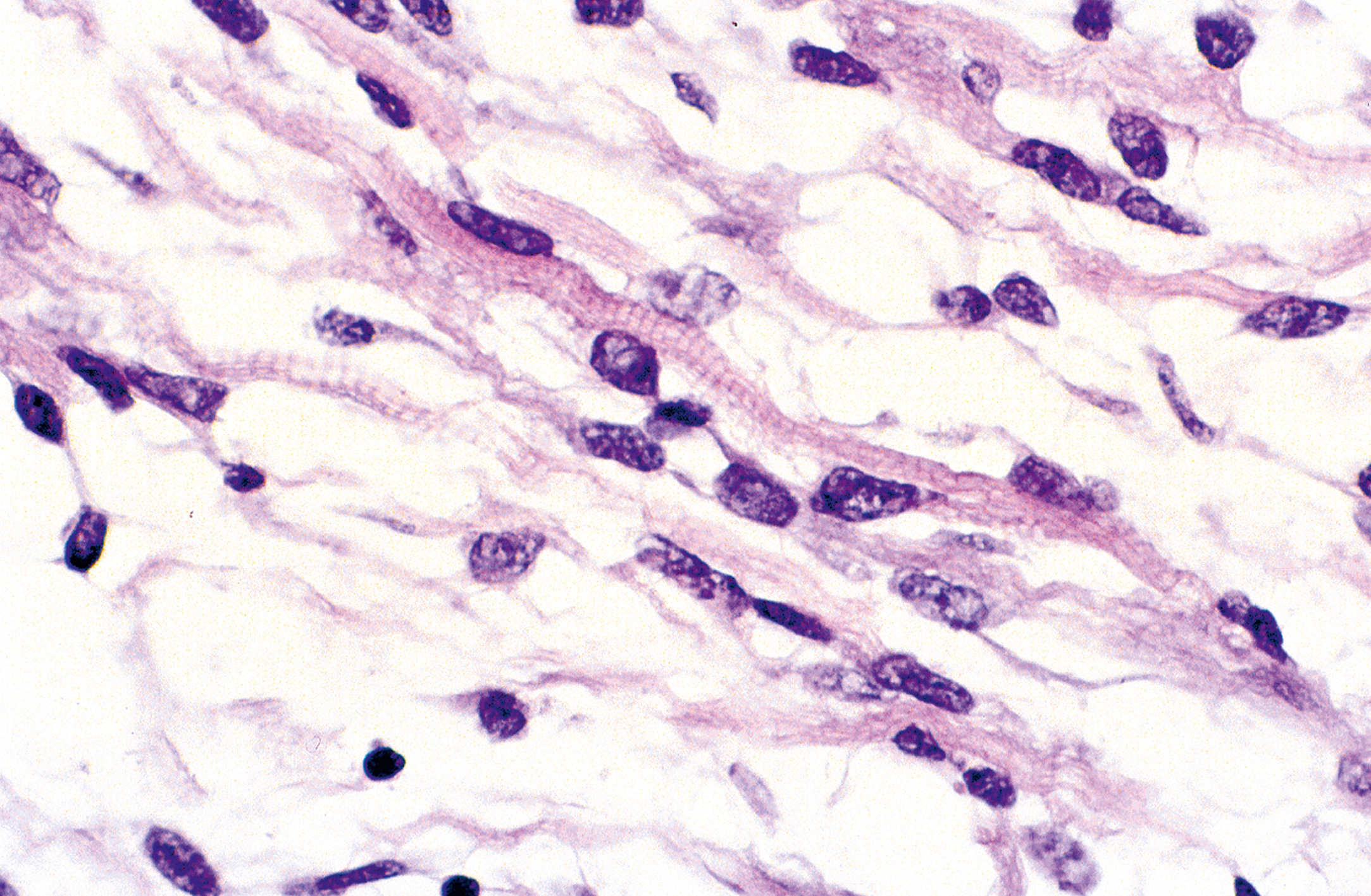 An illustration showing elongated rhabdomyoblasts with clear cross-striations in a case of embryonal rhabdomyosarcoma.