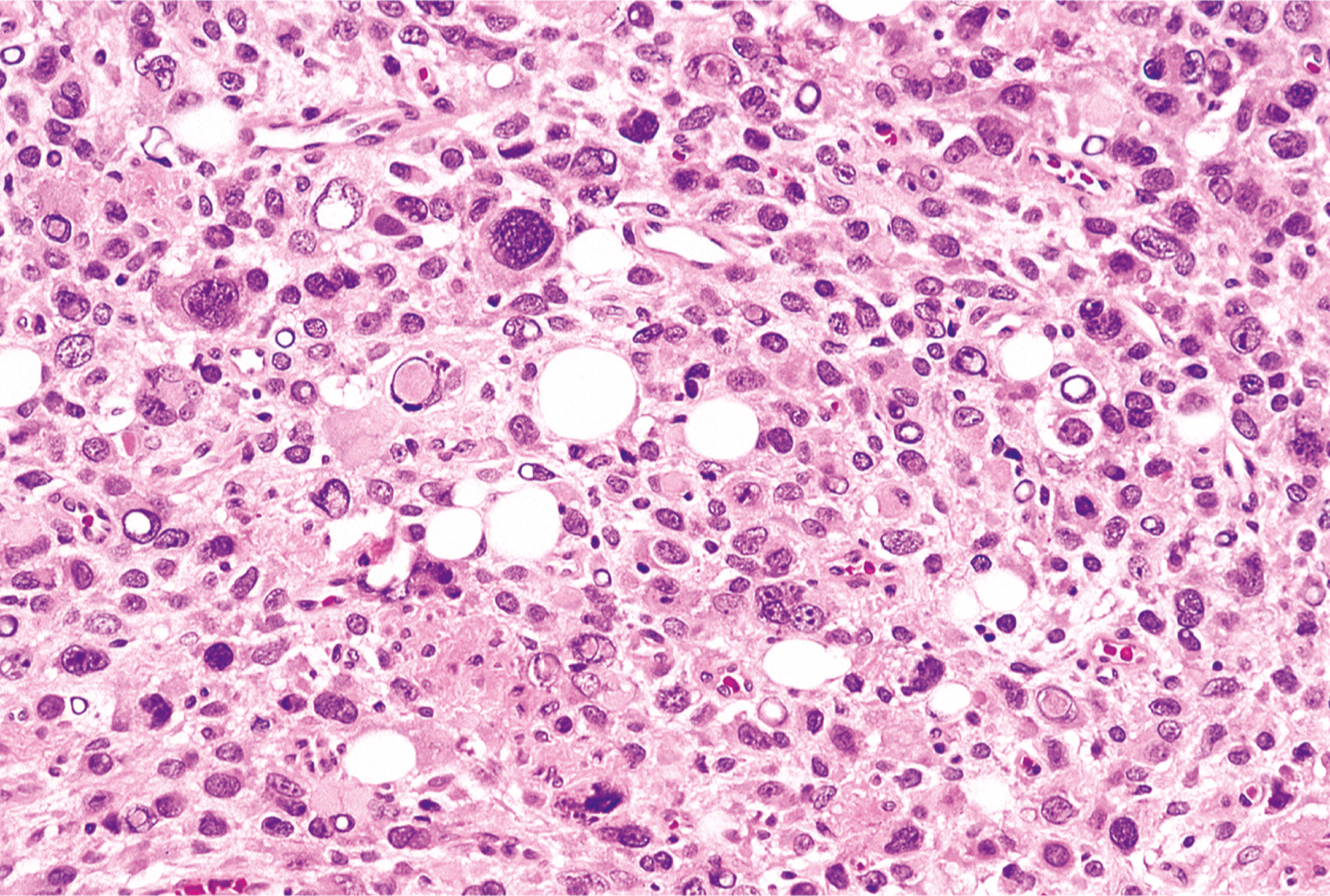An illustration of cells with anaplastic features in a tumor showing irregular spaces.