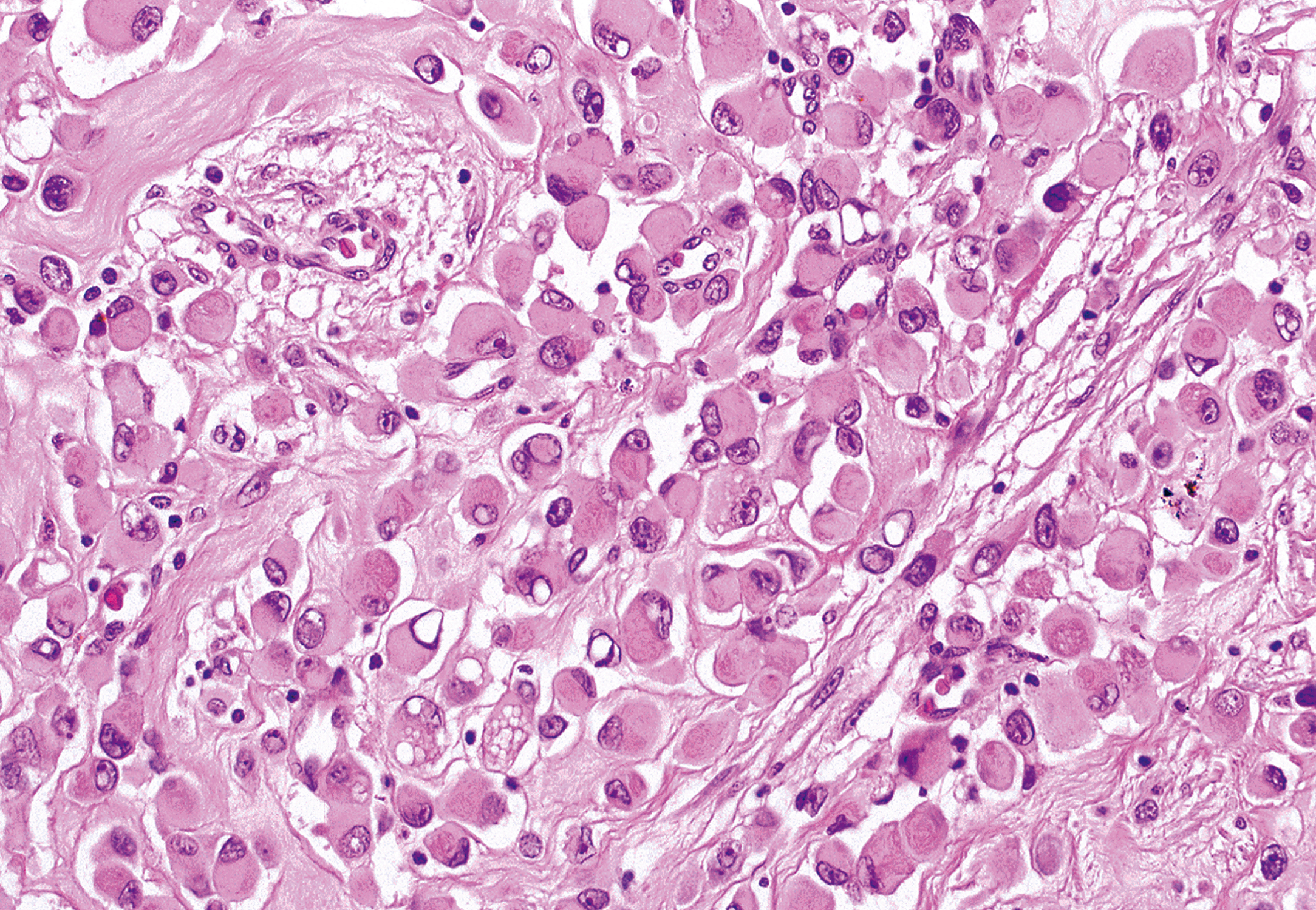 An illustration showing differentiated rhabdomyoblasts in a tumor, often seen in recurrent cases after therapy.
