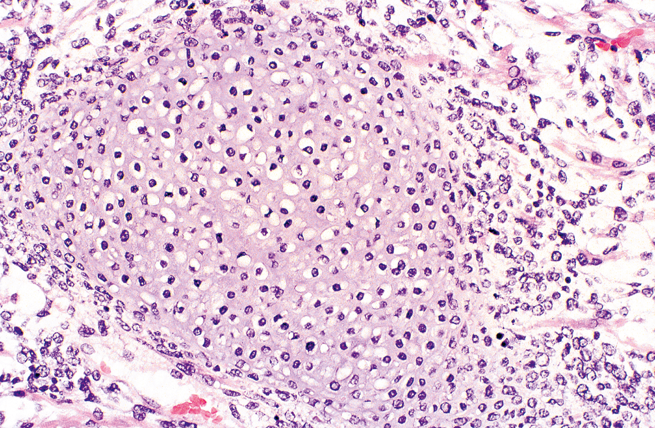 An illustration showing embryonal rhabdomyosarcoma with areas containing foci of immature cartilage, a feature seen in certain tumor types during development.