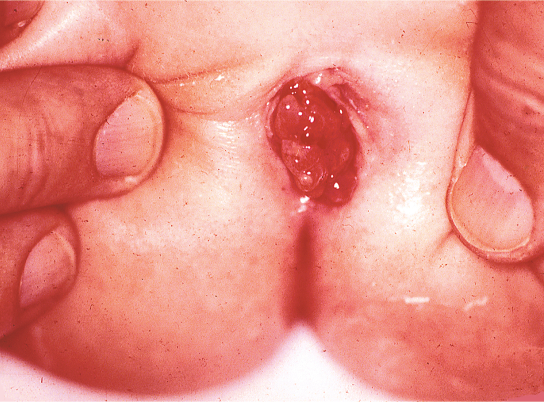 An illustration showing botryoid rhabdomyosarcoma arising in the vagina of a child is depicted in clinical imagery.