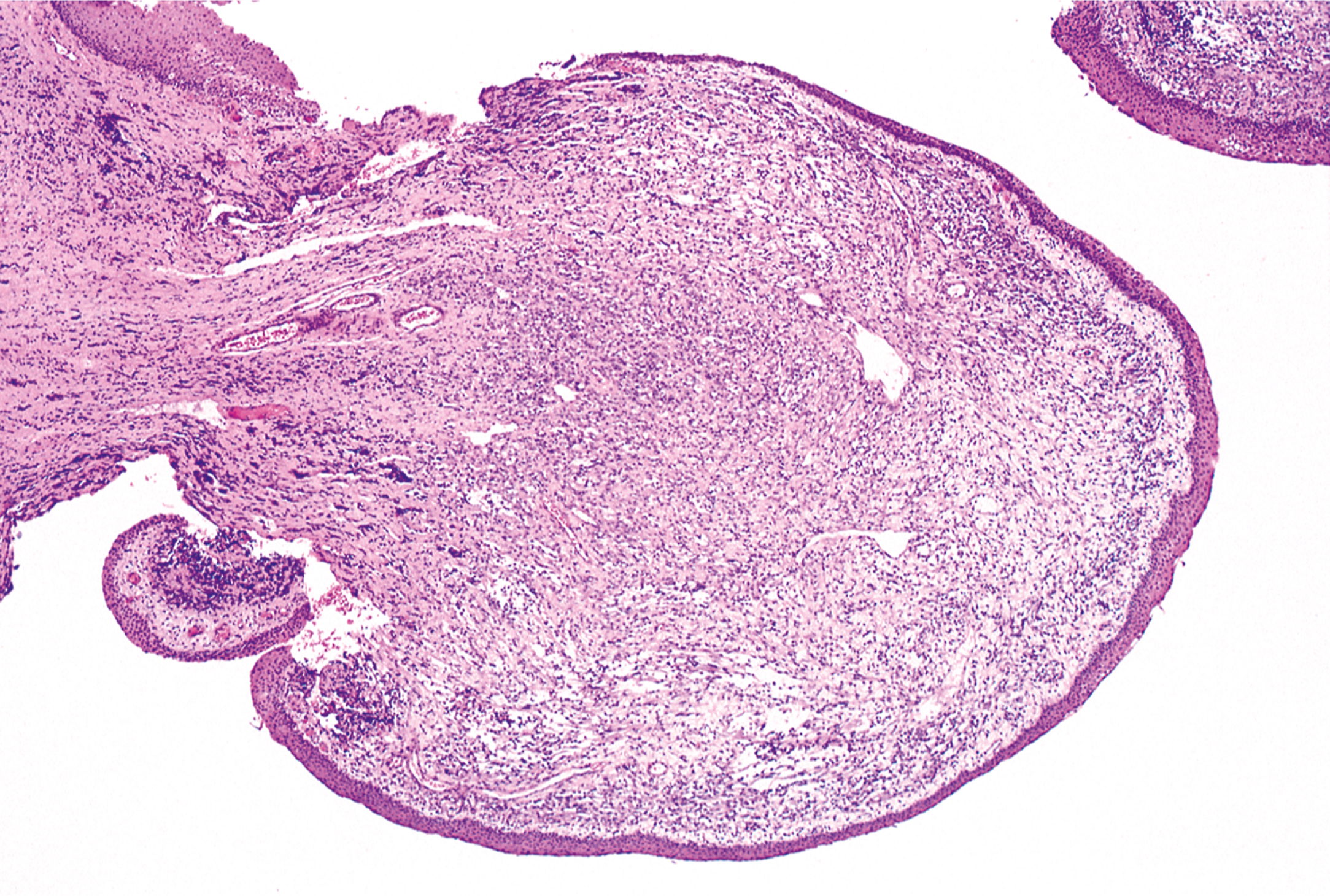 A histological section showing polypoid submucosal growth of botryoid rhabdomyosarcoma with characteristic tissue features.