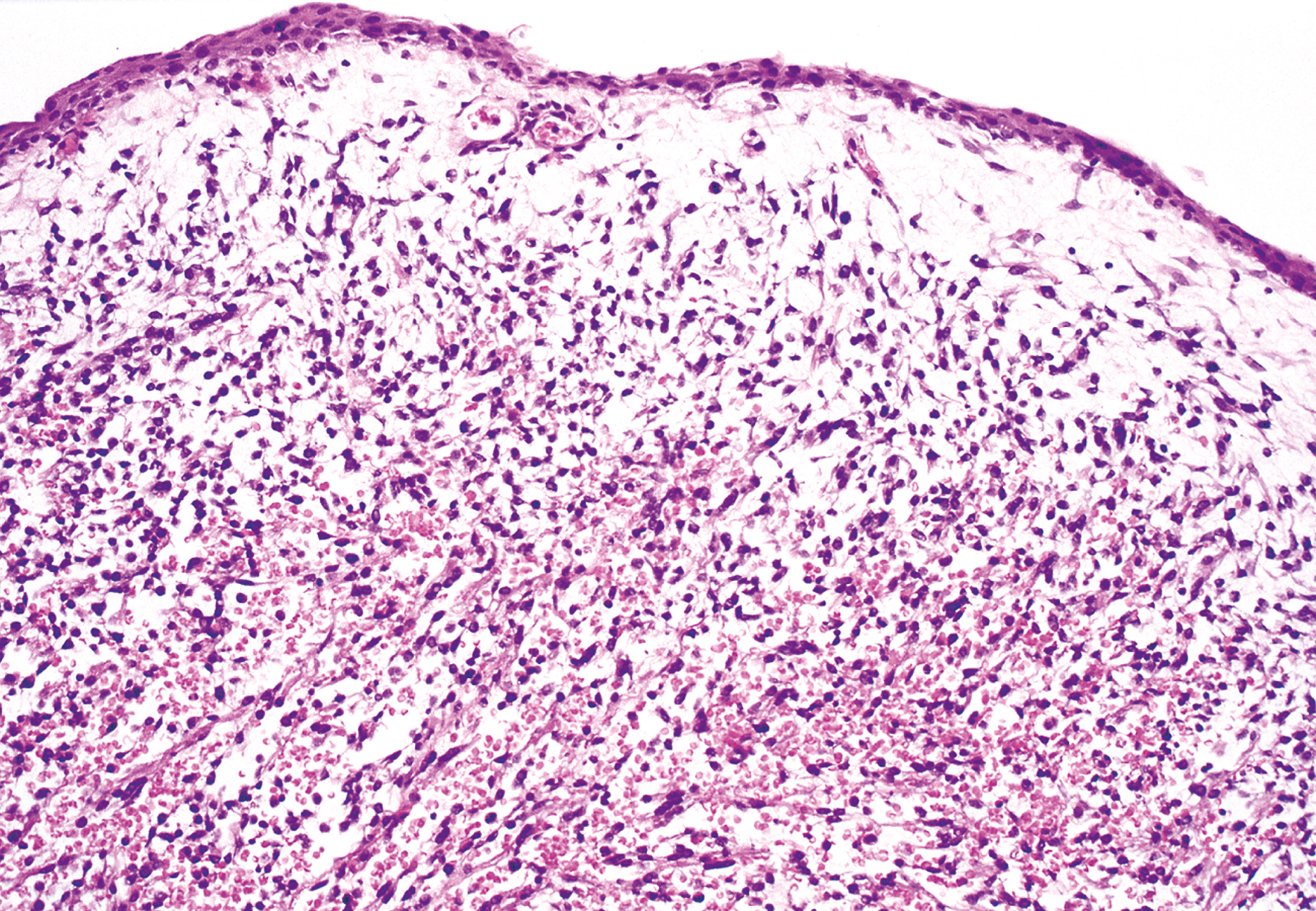 A histological section showing botryoid rhabdomyosarcoma in its typical submucosal location, highlighting characteristic tissue arrangement.