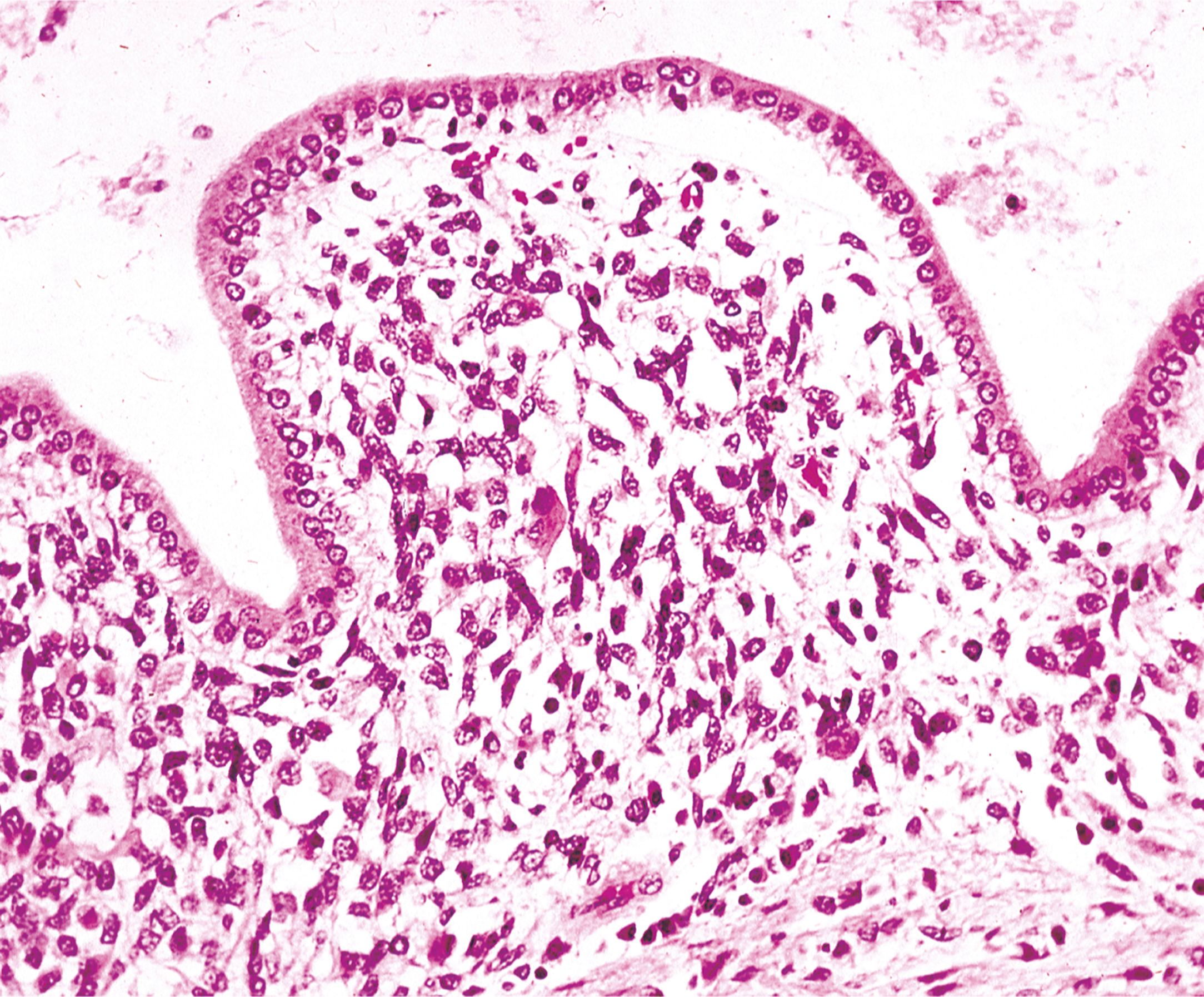 An abnormal tissue growth in the biliary tract resembling botryoid rhabdomyosarcoma, showing cellular structure.