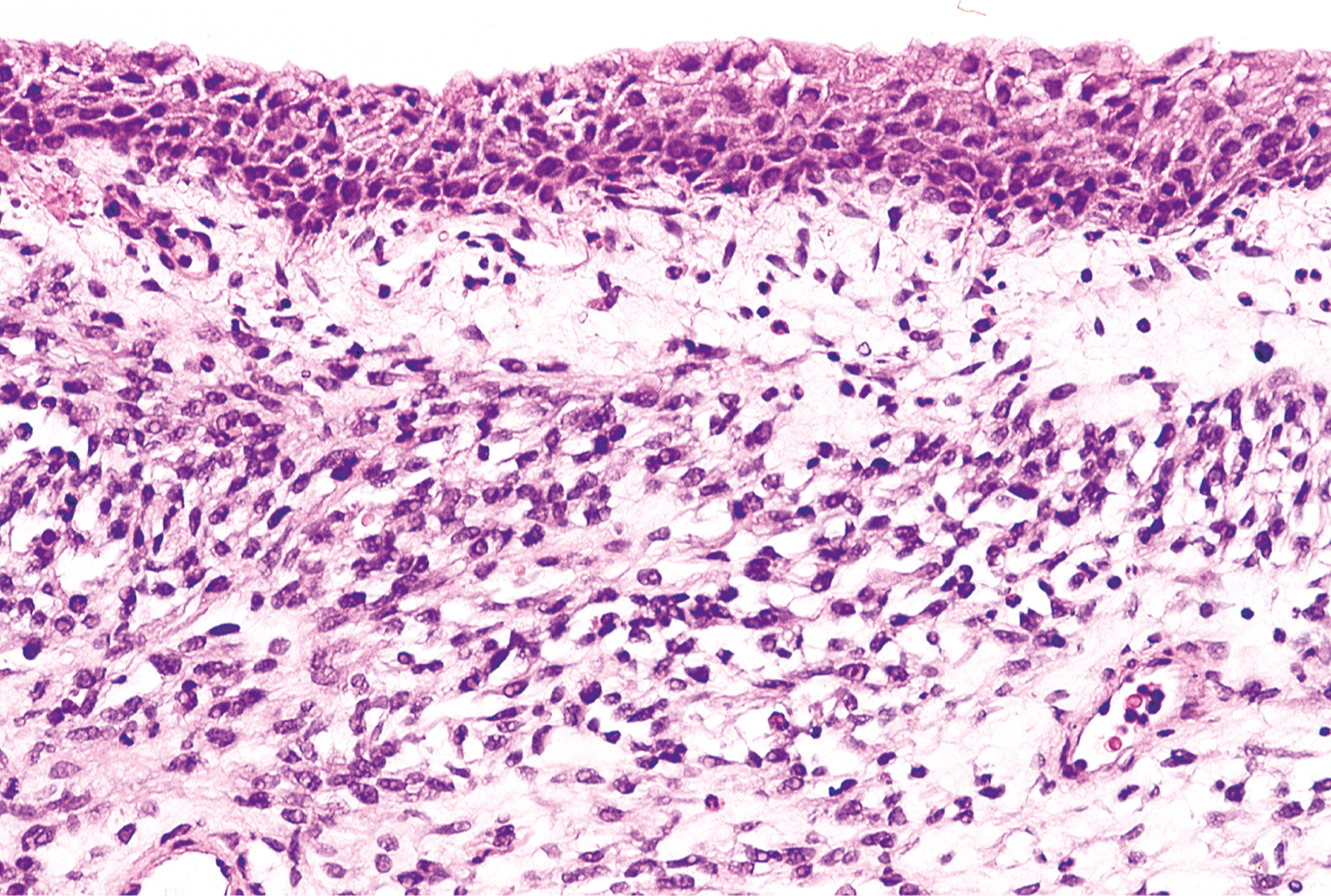 An area displaying the characteristic cambium layer of cells in a submucosal location, showing condensed cells beneath a loose stroma zone.