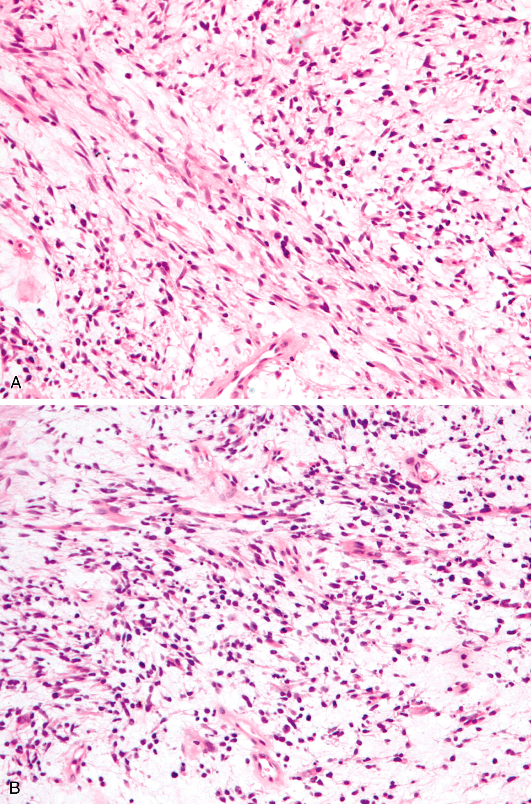 A histological slide of botryoid rhabdomyosarcoma shows a combination of spindled and rounded cellular areas. The histological slide depicts botryoid rhabdomyosarcoma, a type of cancerous tumor. It shows a combination of spindled and rounded cellular areas, with the spindled areas located at the top of the slide and the rounded areas located at the bottom. This combination of cellular patterns is characteristic of botryoid rhabdomyosarcoma and highlights the distinct morphological features of the tumor.