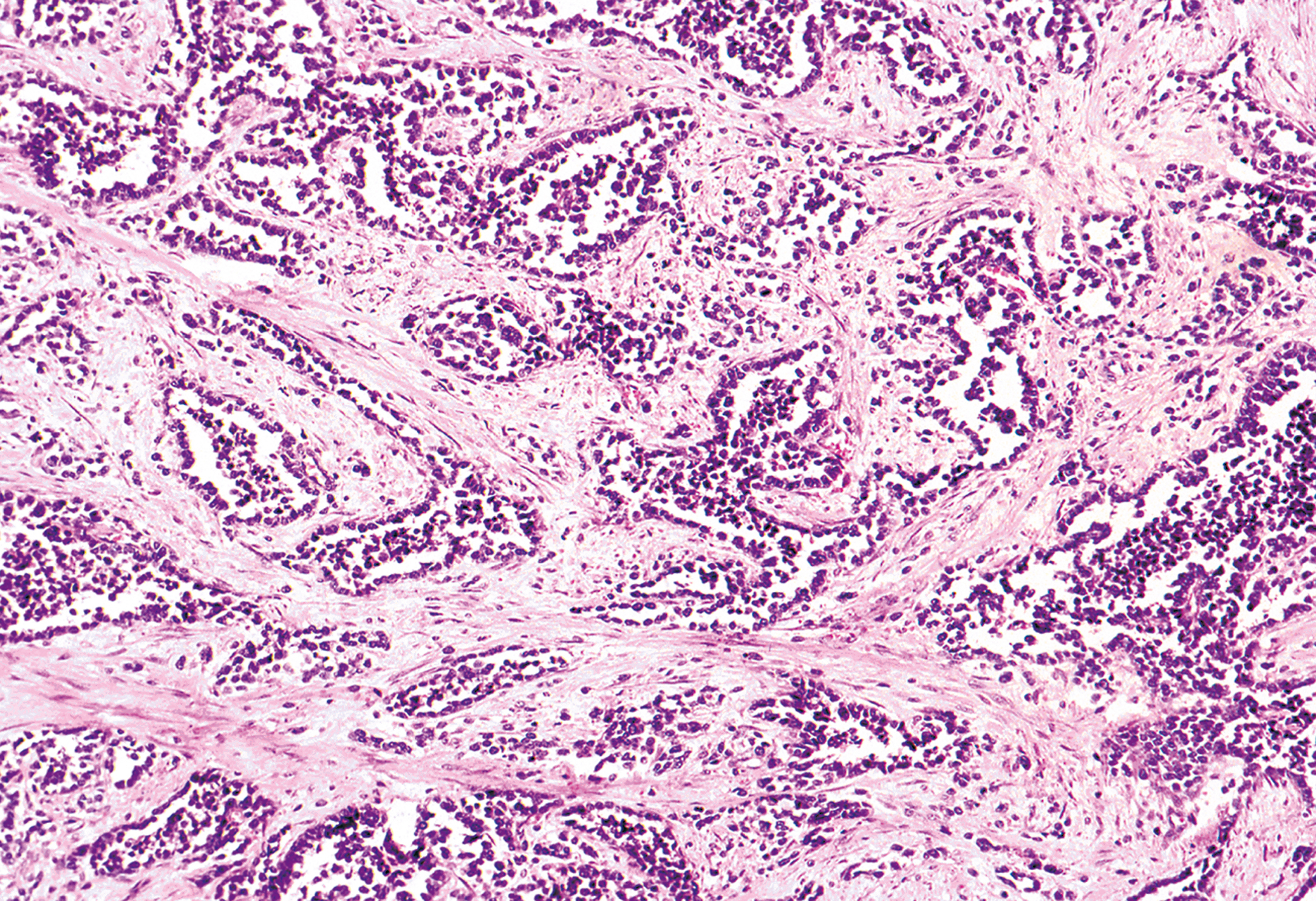 A histological section showing alveolar rhabdomyosarcoma with its characteristic alveolar growth pattern.