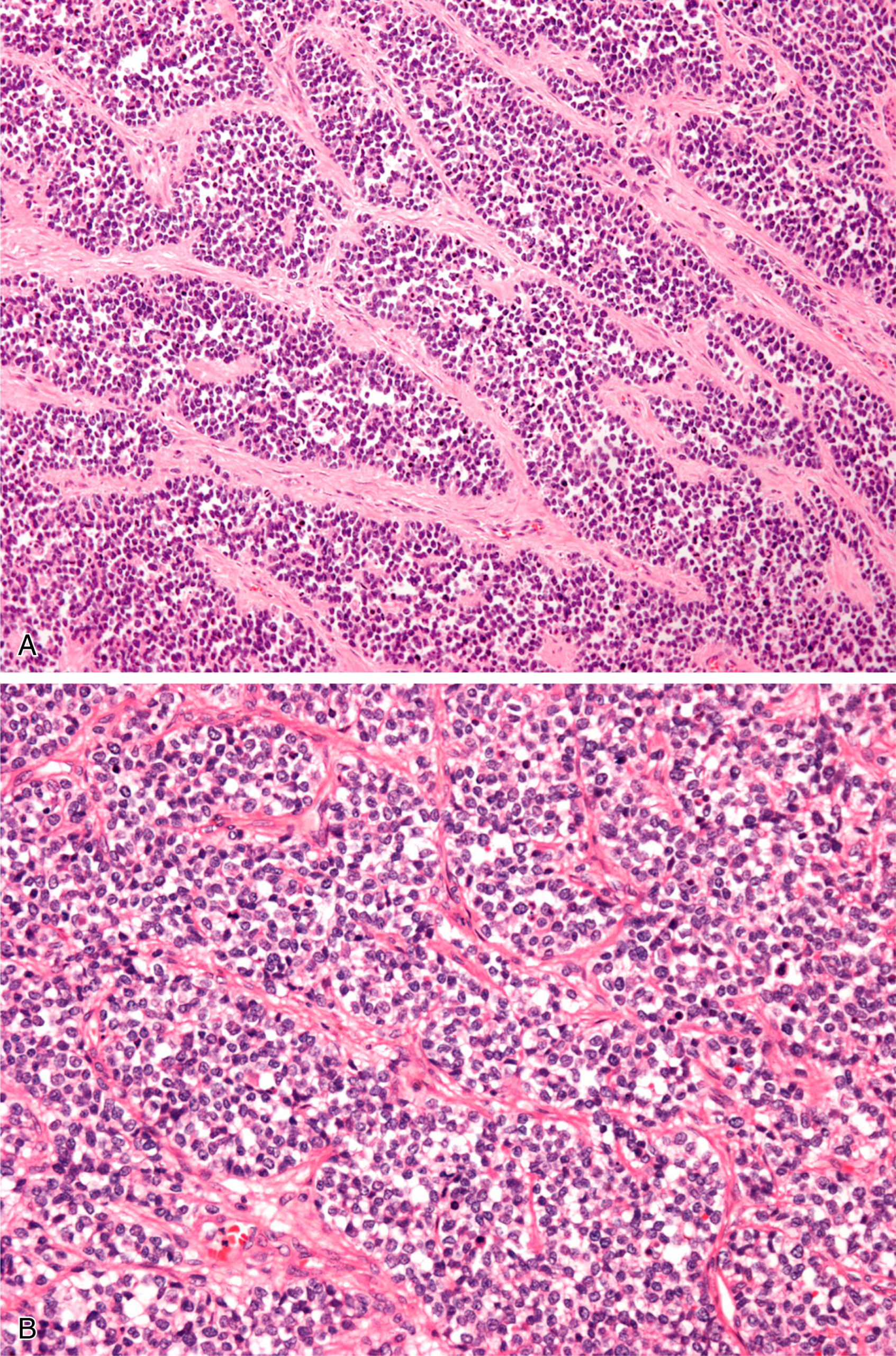 A section showing alveolar rhabdomyosarcoma with centrally located cells in nests, separated by fibrous bands, and cells with relative uniformity. The histological comparison of alveolar rhabdomyosarcoma in a solid pattern. Panel A shows centrally located cells arranged in nests, which have not yet lost cellular cohesion to form a fully developed alveolar pattern. The fibrous bands between the nests provide important clues for diagnosis. Panel B, viewed at high power, shows cells with relative uniformity compared to embryonal rhabdomyosarcoma, further aiding in the distinction between the two tumor types.