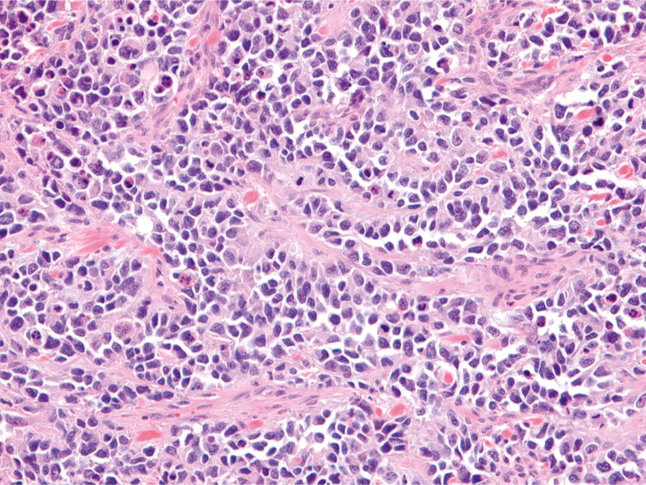 A section showing alveolar rhabdomyosarcoma with increased cellular variation and an emerging alveolar pattern in the tumor.
