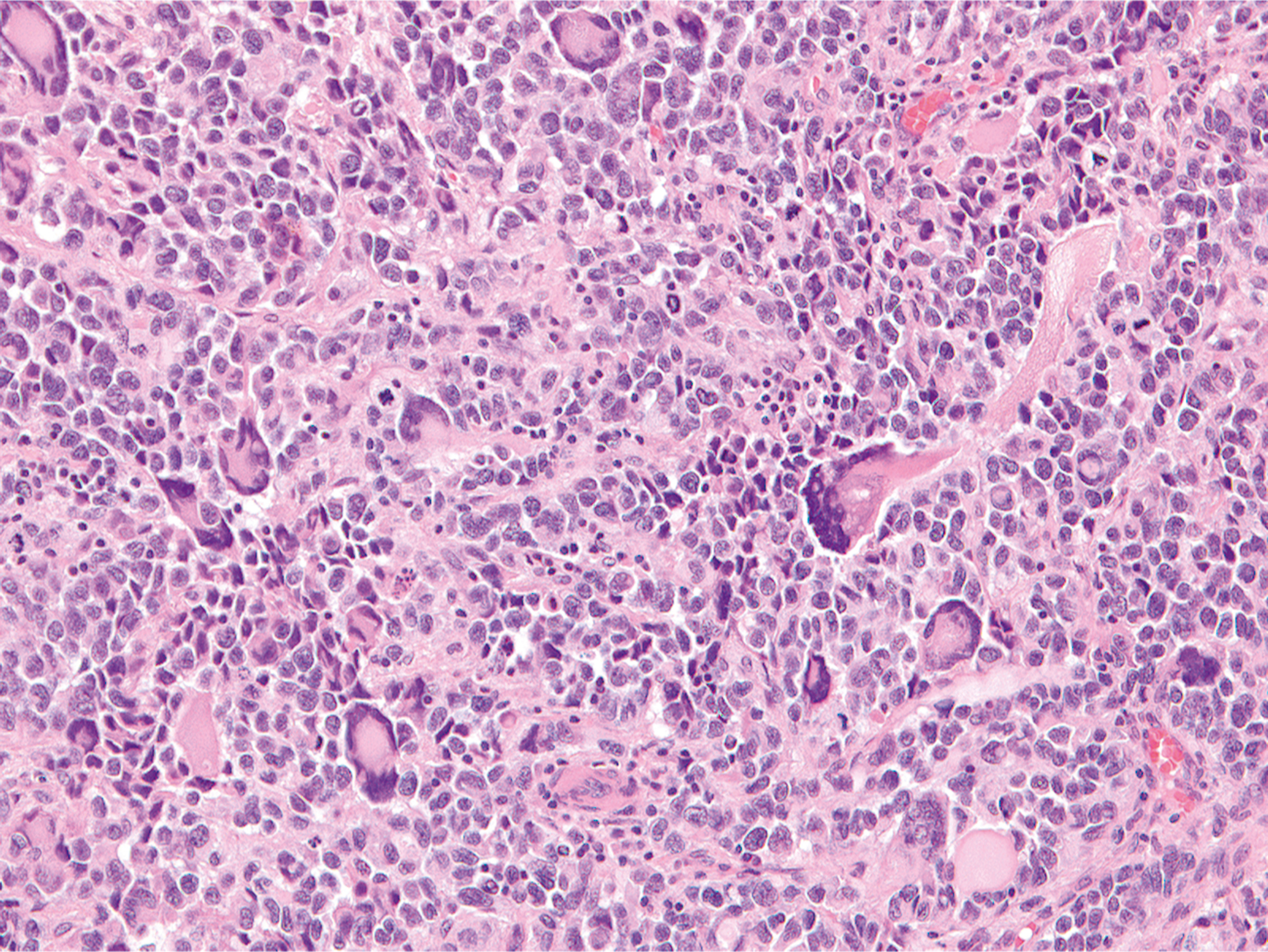A section showing bizarre giant cells in alveolar rhabdomyosarcoma with large, irregular nuclei and abundant cytoplasm.