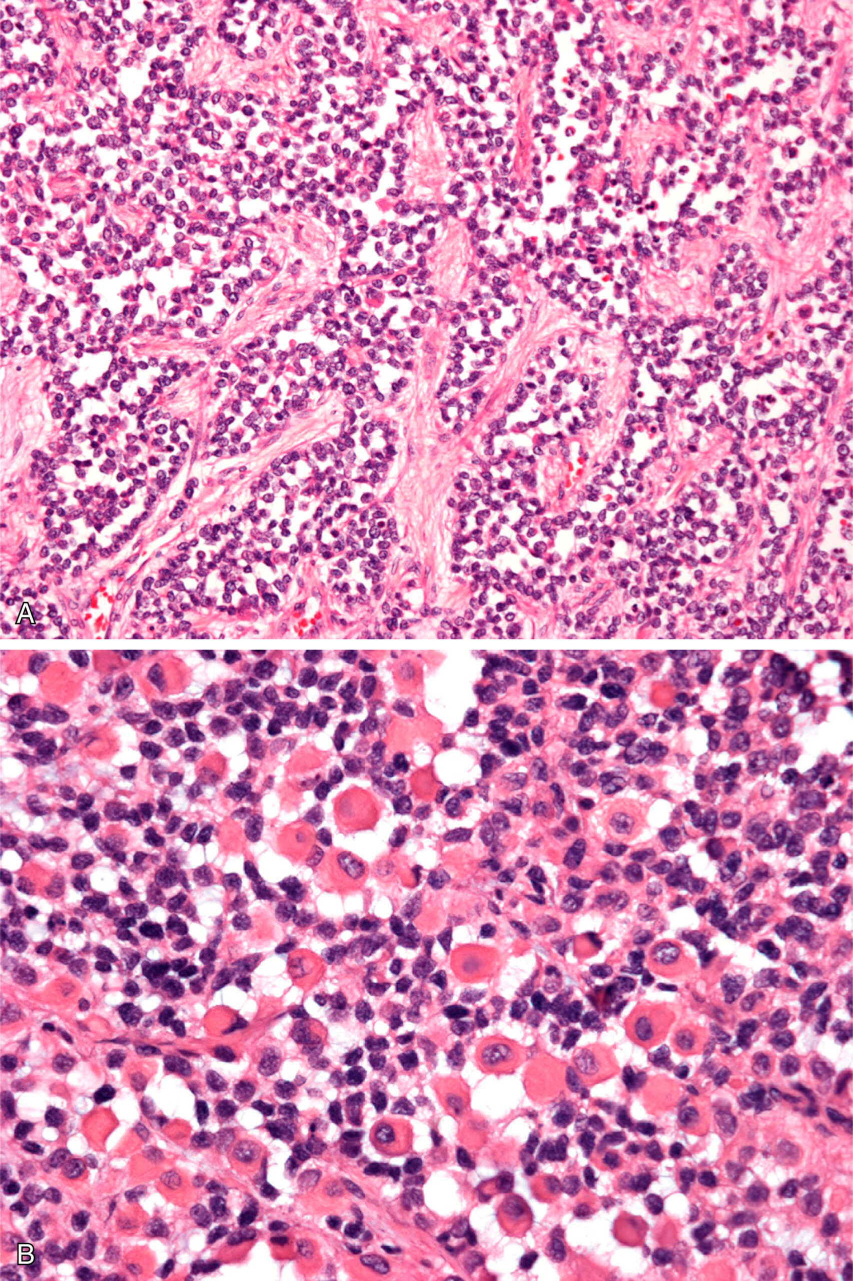A section showing alveolar rhabdomyosarcoma with an evident but less defined alveolar pattern, and numerous differentiating rhabdomyoblasts. The histological comparison of alveolar rhabdomyosarcoma. Panel A shows an alveolar pattern that is evident but not as well defined as in a previous reference. In panel B, numerous differentiating rhabdomyoblasts can be seen within the tumor. These cells display varying degrees of differentiation, with prominent nuclei and cytoplasm, indicative of muscle cell differentiation. The presence of these differentiating cells is a key feature in the tumor's diagnosis and classification.