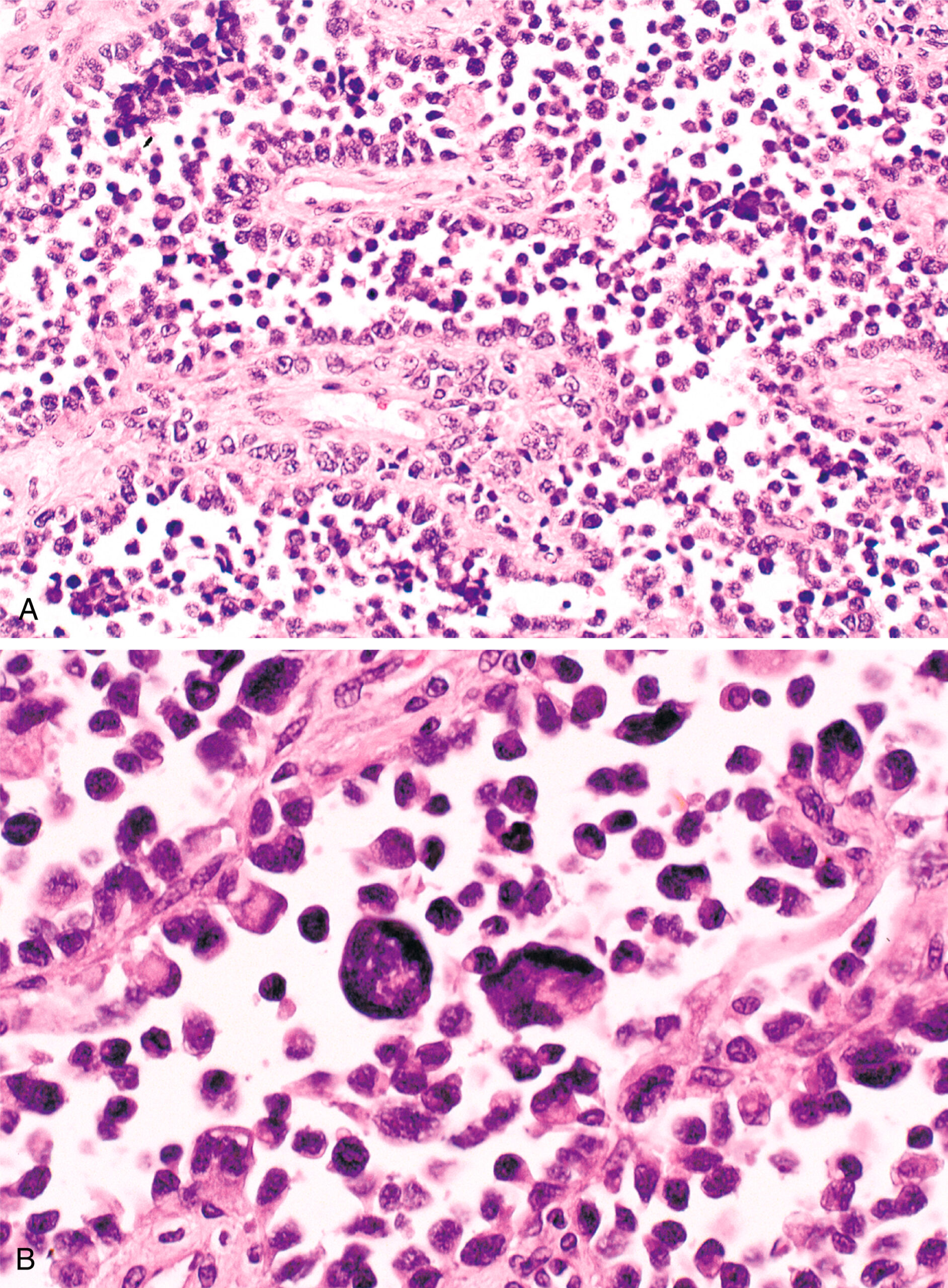 A section showing medium-power and high-power views of alveolar rhabdomyosarcoma, highlighting rare, bizarre giant cells. The histological comparison of alveolar rhabdomyosarcoma at medium power in the upper panel and high power in the lower panel. The medium-power view shows the general structure of the tumor, while the high-power view reveals rare and bizarre giant cells. These giant cells, with irregular and oversized nuclei, are a distinctive feature of alveolar rhabdomyosarcoma, aiding in its diagnosis. Their presence highlights the tumor's unique cellular composition.