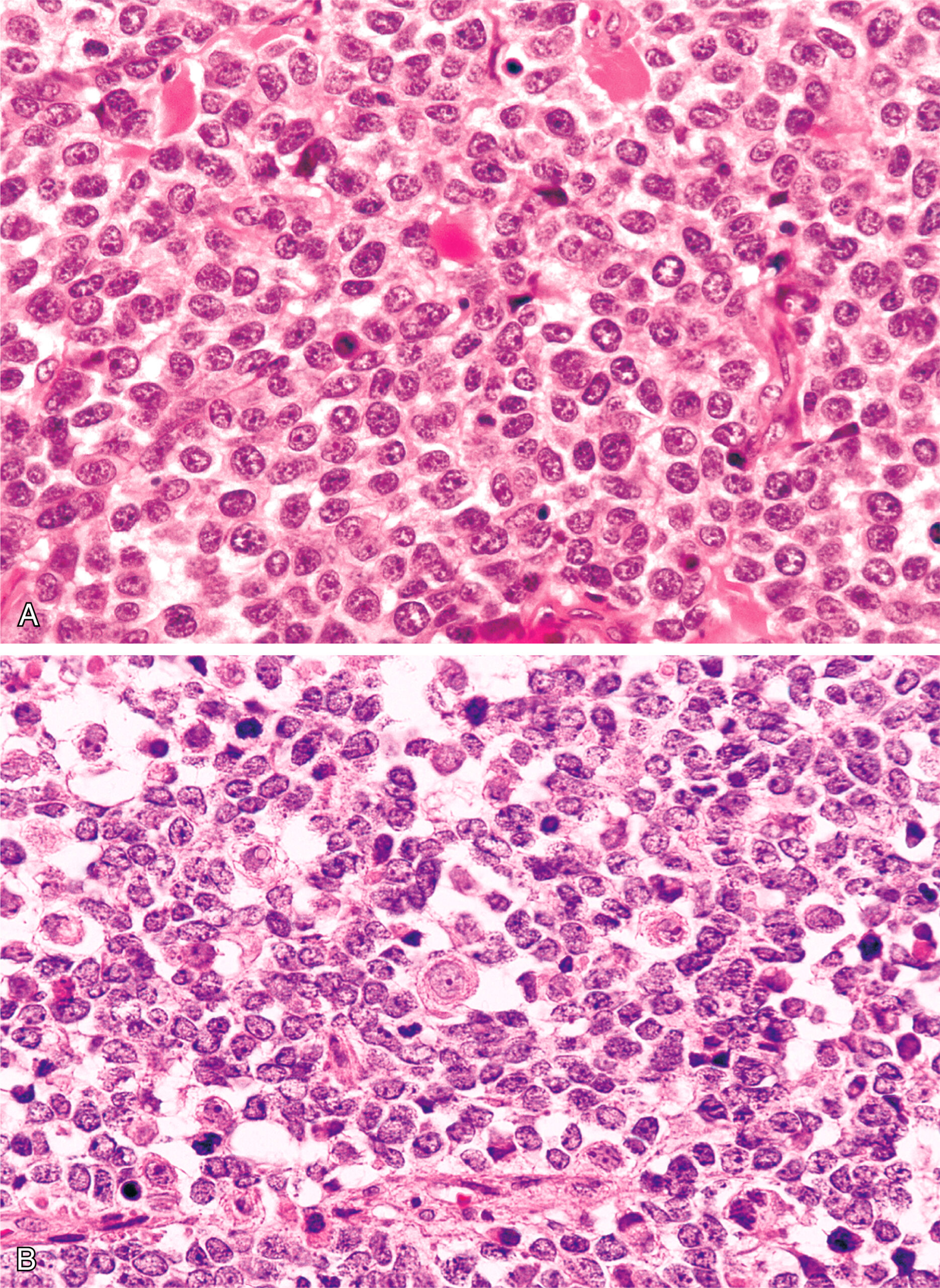 A section showing alveolar rhabdomyosarcoma with more uniform cells compared to the more varied cell morphology seen in embryonal rhabdomyosarcoma. The histological comparison shows cells in alveolar rhabdomyosarcoma with a more uniform appearance, as seen in the upper panel. In contrast, the lower panel depicts embryonal rhabdomyosarcoma with a greater variation in cell morphology. The more uniform arrangement of cells in alveolar rhabdomyosarcoma helps distinguish it from the more heterogeneous cellular composition characteristic of embryonal rhabdomyosarcoma, aiding in their differentiation.