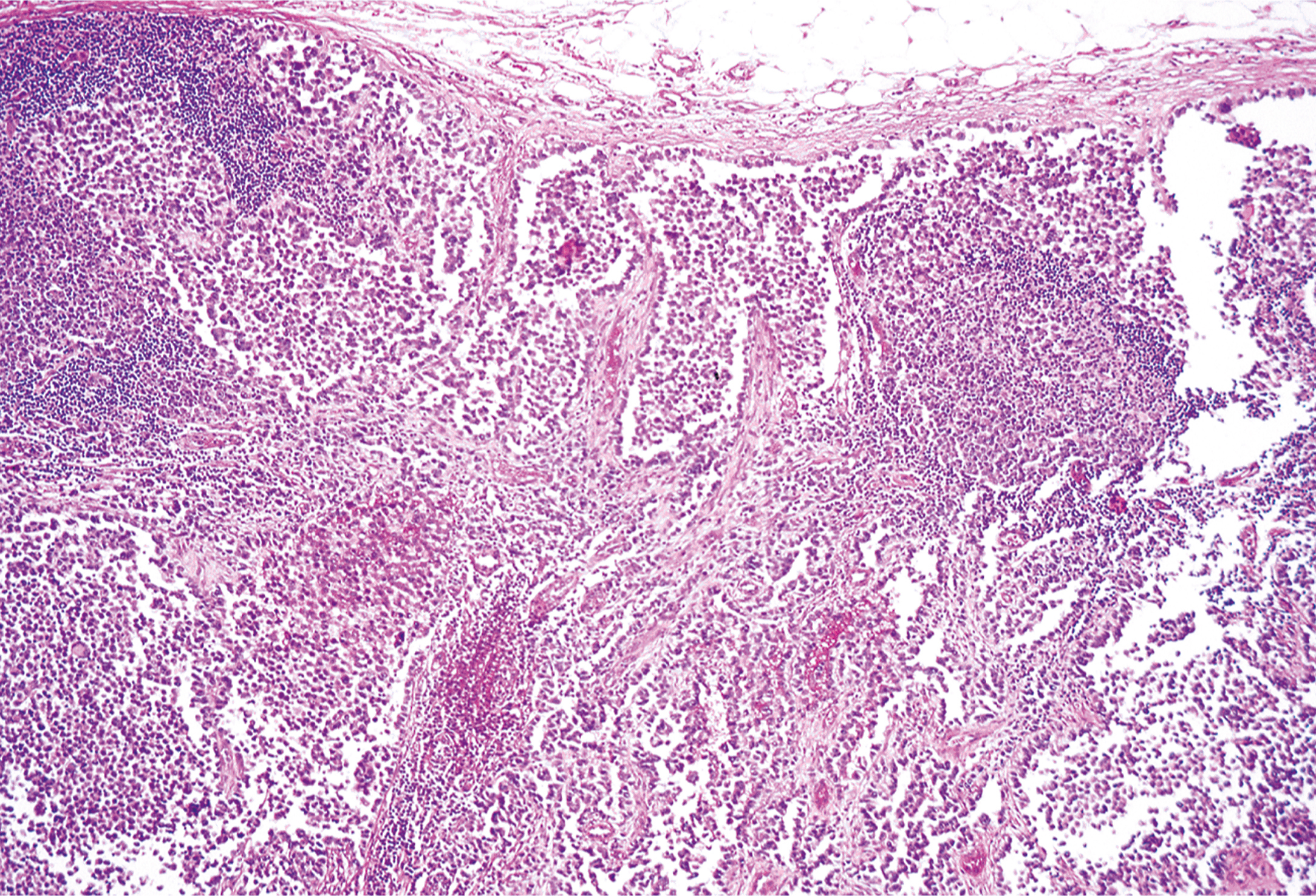 A histological image showing metastatic alveolar rhabdomyosarcoma in a lymph node with an alveolar pattern in the metastasis.