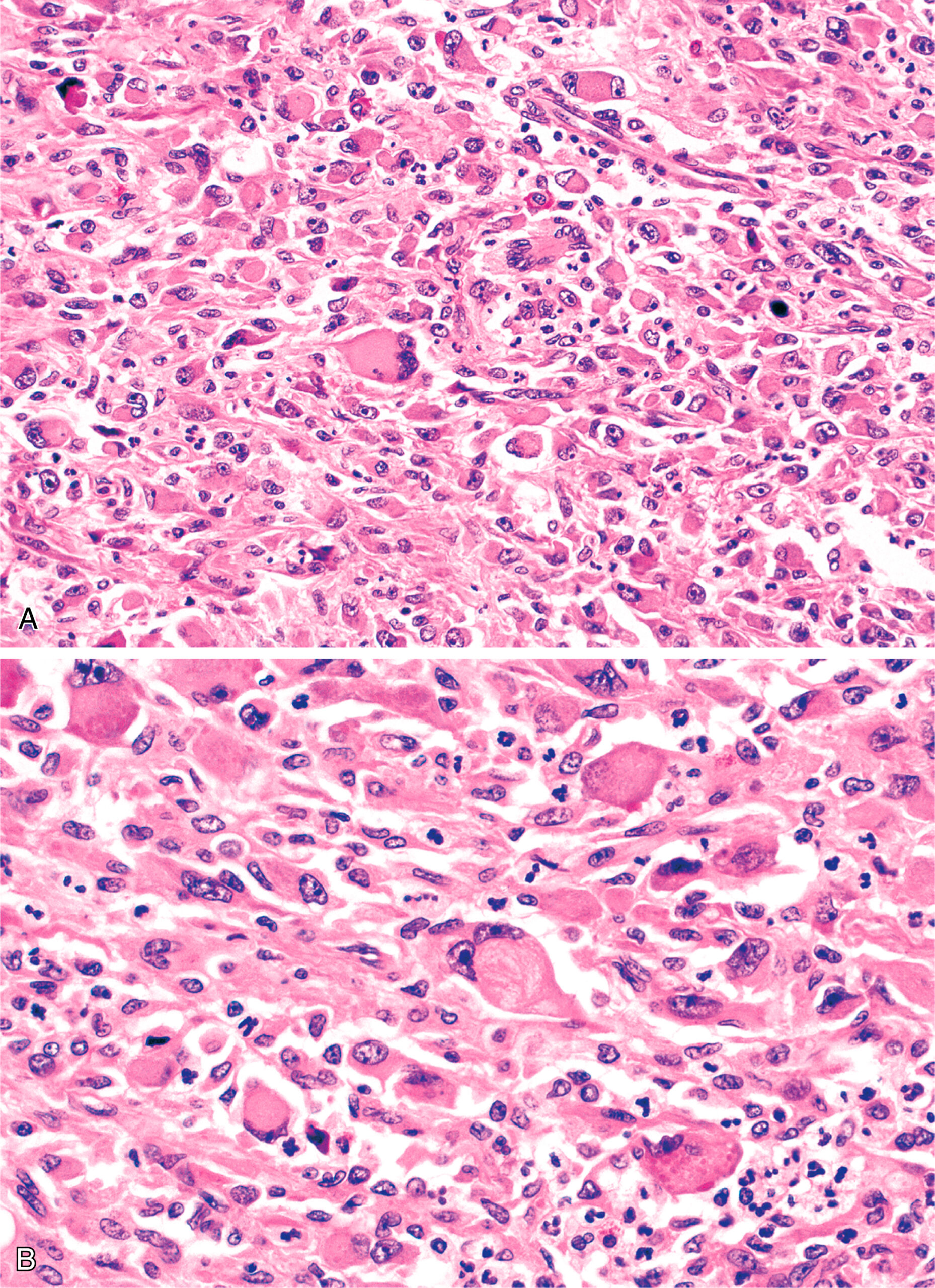 A histological slide of pleomorphic rhabdomyosarcoma shows an admixture of spindled and rounded rhabdomyoblasts. The histological slide illustrates pleomorphic rhabdomyosarcoma, a type of soft tissue cancer. It displays an admixture of spindled and rounded rhabdomyoblasts. The spindled cells are elongated, while the rounded cells are more spherical in shape. This combination of cell types is characteristic of pleomorphic rhabdomyosarcoma, reflecting the tumor's diverse cellular morphology.