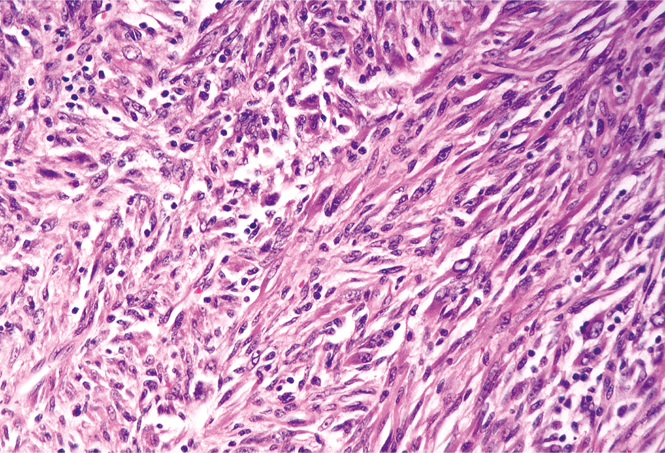 A histological section showing pleomorphic rhabdomyosarcoma with a fascicular architecture, featuring predominantly spindle-shaped cells.