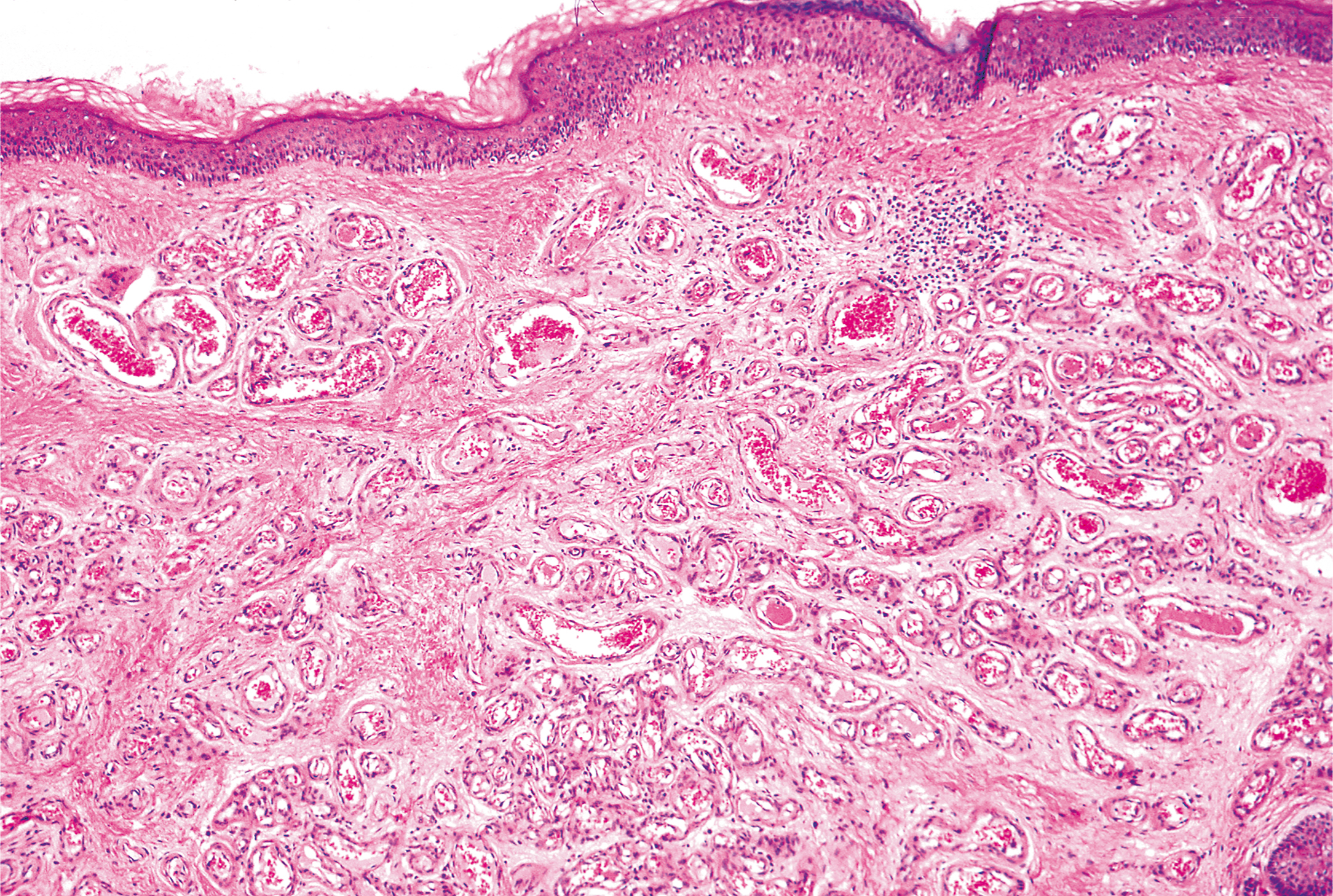 A histological section presents adult capillary hemangioma, composed of numerous small vascular channels distributed throughout the dermis.