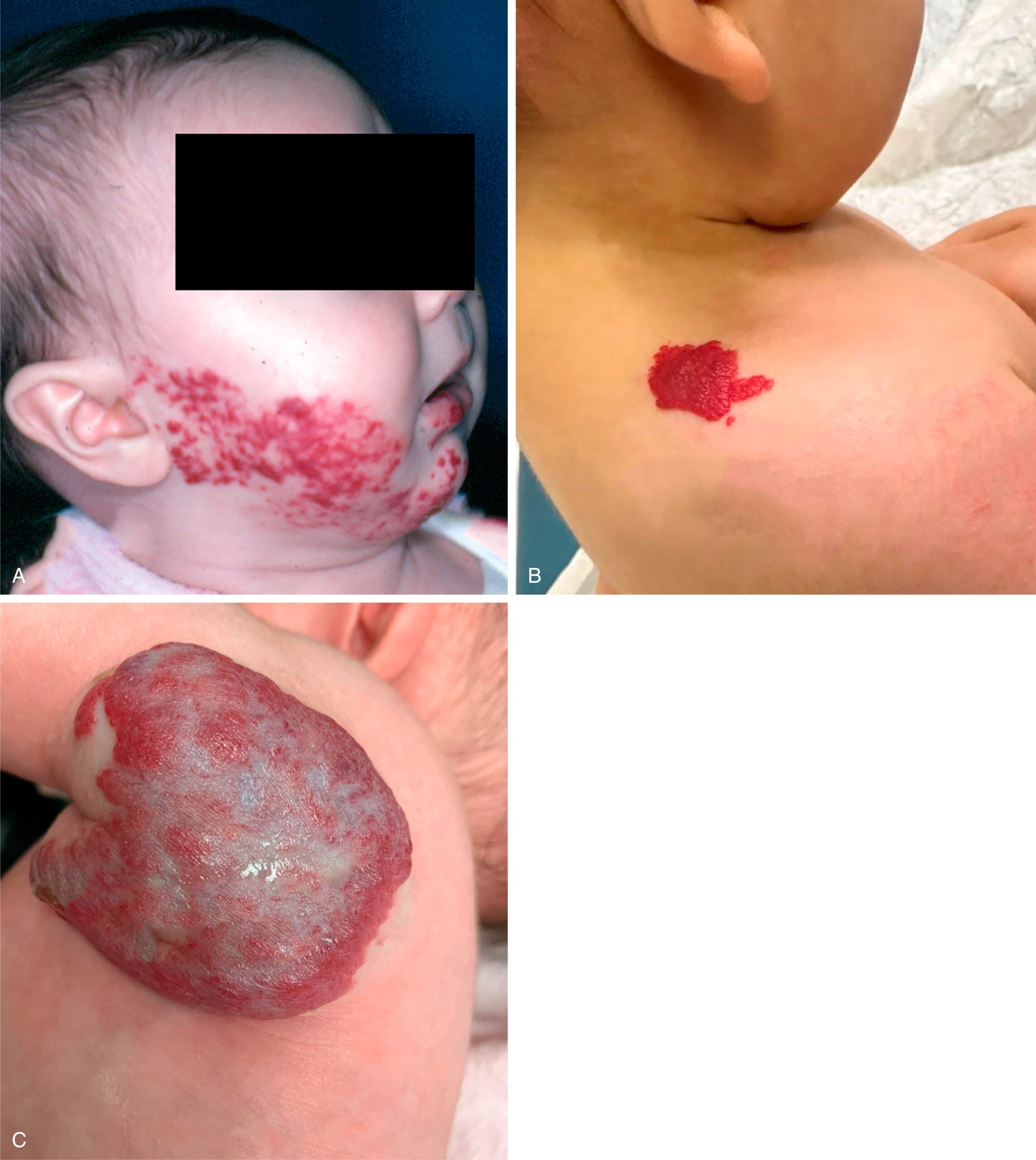 A set of three clinical photos of an infant with raised and flat vascular lesions on the cheek, upper back, and foot with varying surface texture and size.