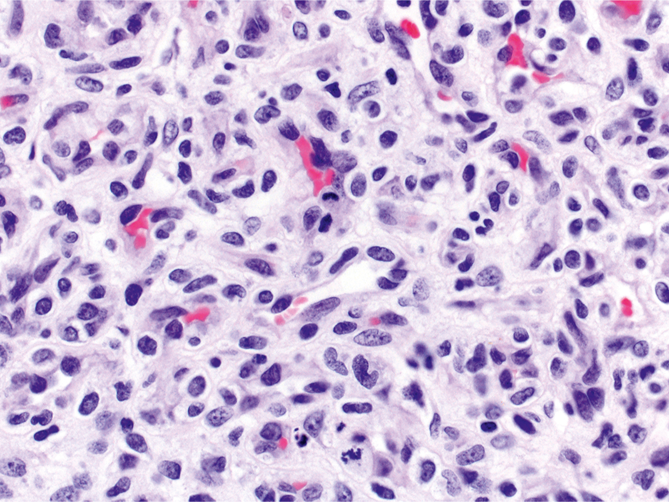 A microscopic section with numerous capillaries lined by plump endothelial cells and surrounding pericytes with minimal formation of vascular lumens.