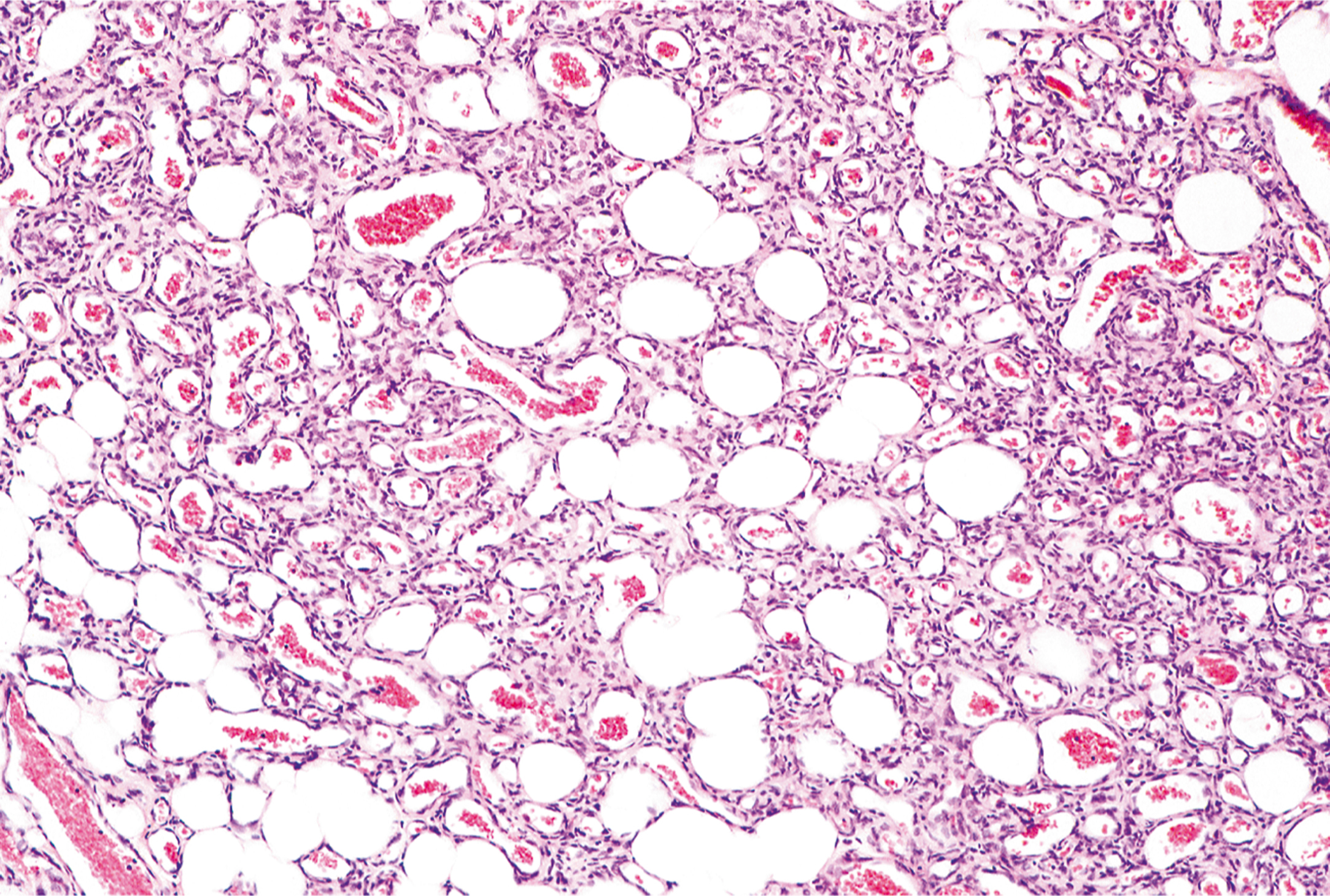 A histological section displays numerous canalized vessels with large lumens and flattened endothelial cells throughout the tissue.