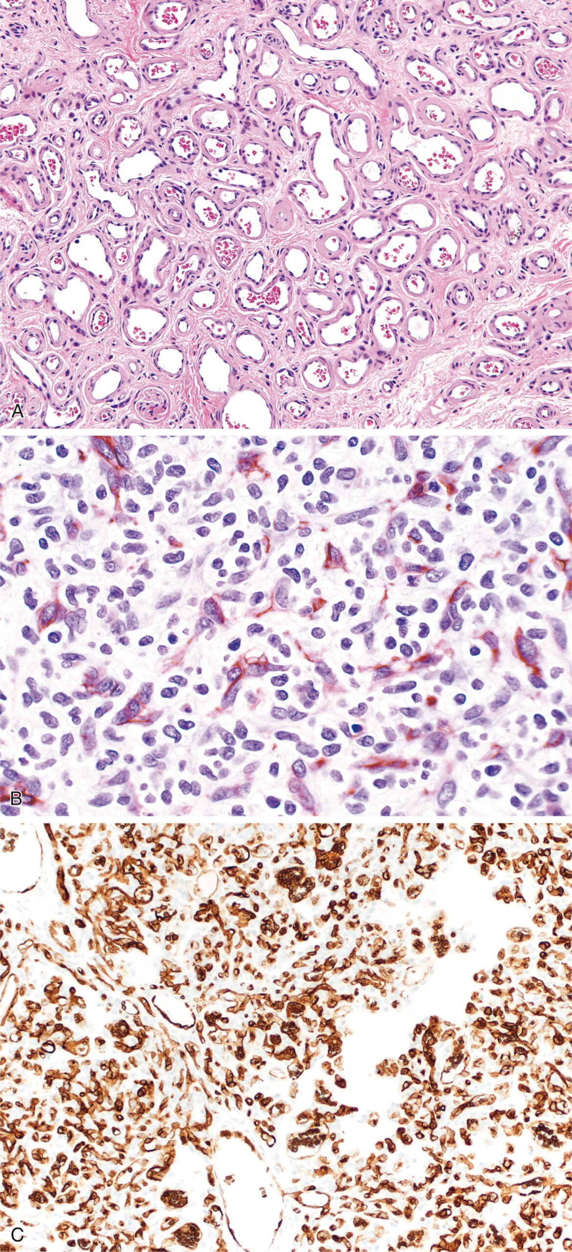A set of three histological sections displays wide-lumen capillaries with fibrous tissue, mature and immature endothelial cells, and erythrocytes with endothelial staining. The top histological section contains multiple capillaries with wide lumens and thickened basement membranes. These capillaries are separated by fibrous connective tissue. The middle section includes an immunostained sample that presents a dense network of mature endothelial cells. Scattered nonreactive cells are also present, representing a combination of immature endothelial cells and pericytes. The bottom section contains another immunostained sample in which erythrocytes and endothelial cells are marked, revealing a widespread distribution of labeled vascular elements throughout the tissue.