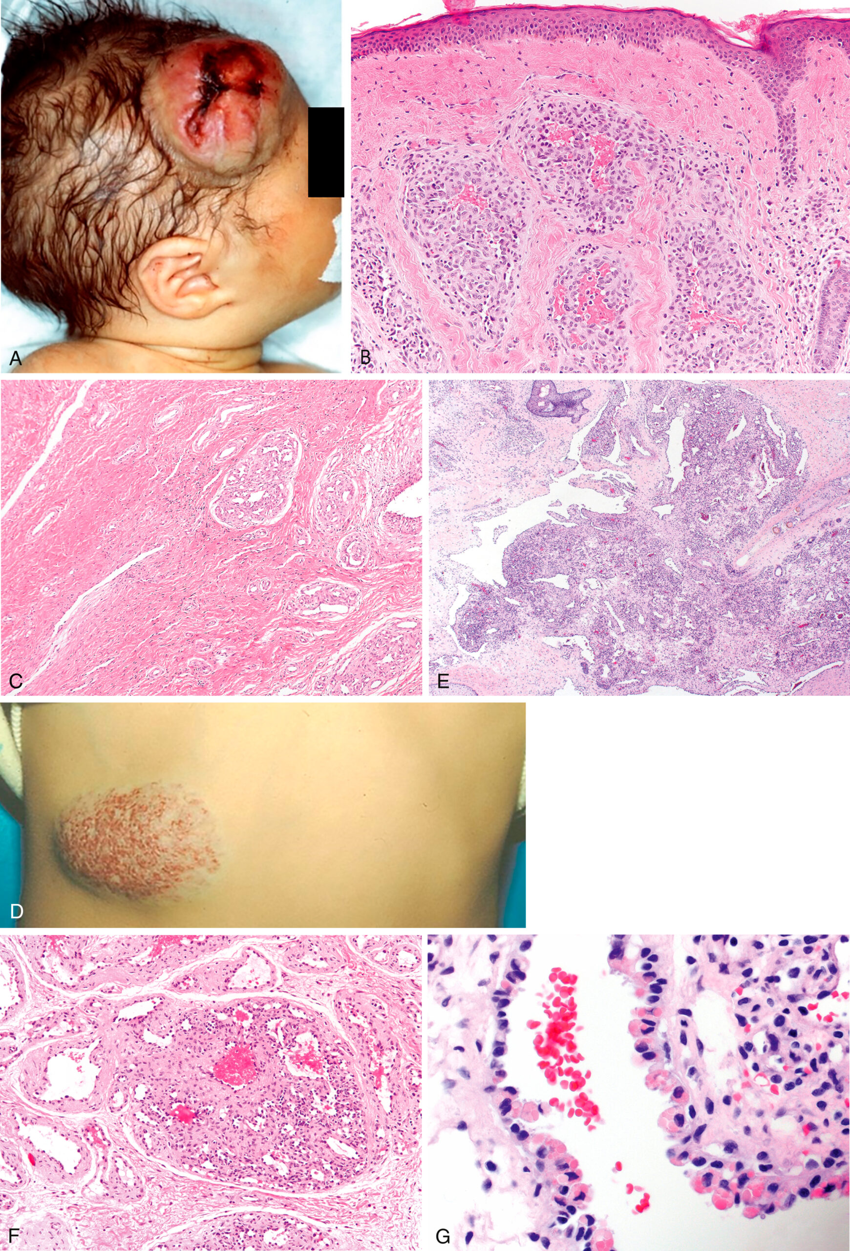 A set of seven panels labeled A to G depicts dermal lobules, lesions on the skin of a young child, variable lobules, fibrotic centers, and endothelial cells with cytoplasmic inclusions. The first panel A shows a photo of a large mass with central ulceration and surface vessels present on the scalp of a newborn near the ear, with surrounding skin and hair visible. The second panel B presents a histological section with small lobules located within the dermis, containing enlarged central vascular channels surrounded by minimal endothelial lining. The third panel C displays a fibrous tissue zone with reduced or vanishing lobules and a few remaining draining vascular channels embedded within the dense stroma. The fourth panel D displays a clinical view of a flattened, dome-shaped lesion on the skin of a young child. The lesion is raised from the surface, well-circumscribed, and covered with prominent surface vascular markings. The surrounding skin appears intact. The fifth panel E contains a histological section displaying lobules of different sizes and shapes, along with prominent arteries and veins located within and between the lobules. The sixth panel, F, presents a single lobule containing thin-walled peripheral capillaries with hobnailed endothelial cells, a fibrotic center with large vascular channels, and thick-walled vessels located between lobules. The seventh panel G presents a high magnification view of endothelial cells containing cytoplasmic eosinophilic inclusions. The endothelial cells appear elongated with dense nuclear staining. Red blood cells are visible within the nearby vascular spaces.