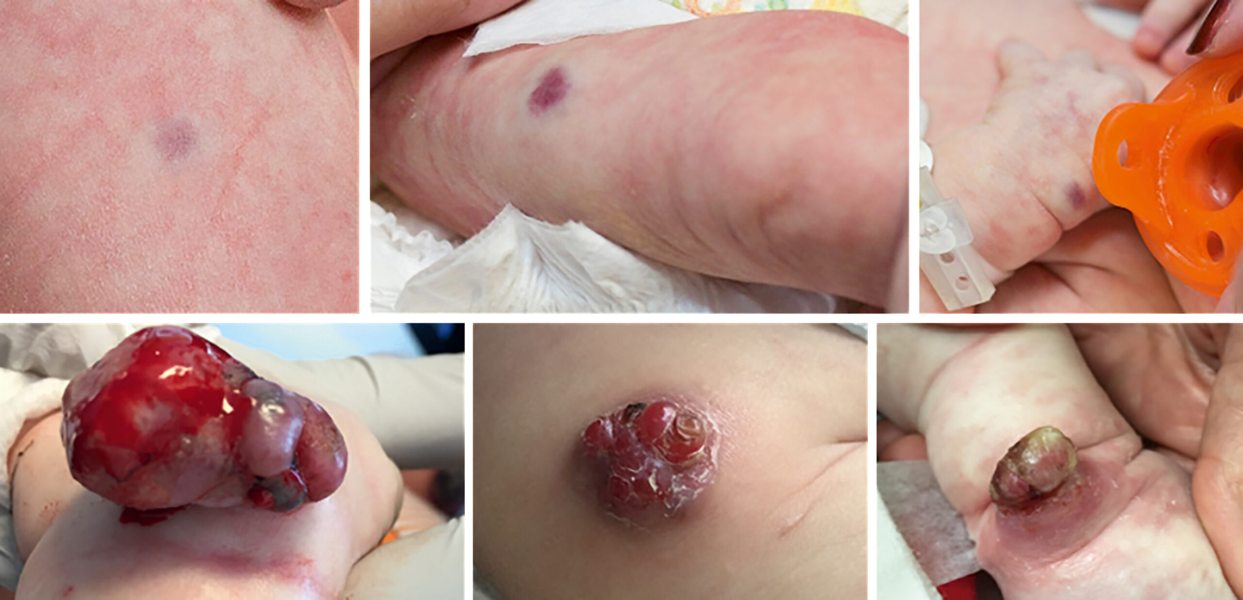 A set of six photos depicts multiple skin lesions on limbs and torso at birth and at six months, initially flat, then developing into raised, lobulated, and ulcerated nodules. The first row contains three photos displaying skin lesions at birth, including flat, round lesions on the torso and limbs, with a smooth surface and mild central darkening. The second row contains three photographs of the same anatomical sites at six months of age. These lesions appear as raised, lobulated nodules with irregular surfaces and some ulceration. One lesion on the foot presents as a large, protruding mass, another on the torso as a rounded, shiny nodule, and a third as a crusted lesion on the finger. The skin around the lesions appears slightly stretched in some areas.