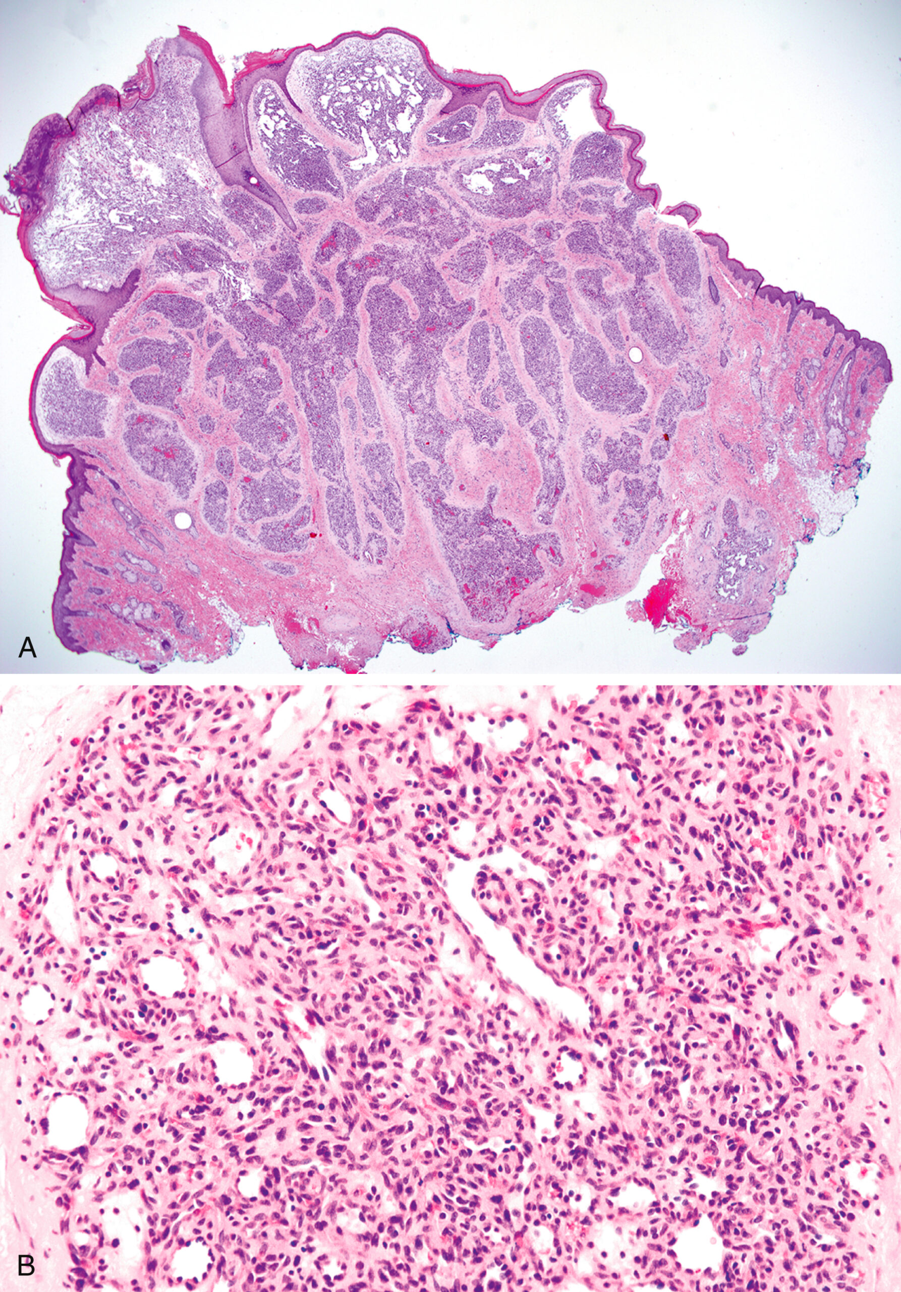 A set of two histological sections of pyogenic granuloma displays exophytic lobular architecture and clusters of small vessels with dense cellular stroma. The first panel A presents a low-magnification histological section of a pyogenic granuloma with an exophytic architecture composed of multiple lobules. These lobules extend outward from the surface and are separated by fibrous septa. The tissue appears well-organized into discrete areas of growth. The second panel B presents a high magnification histological section of the same lesion. Numerous small vascular channels are organized in lobular clusters within a cellular stroma. The vessels have thin walls and are surrounded by densely packed spindle-shaped and oval cells. The stromal background contains scattered inflammatory cells.