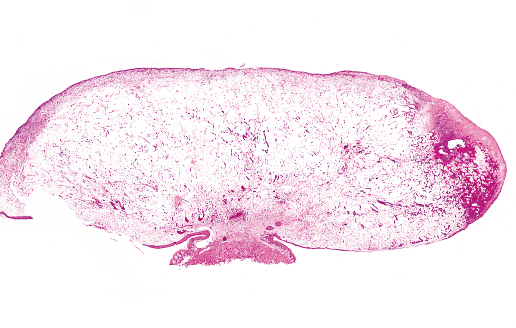 A histological section of pyogenic granuloma displays a lobular structure with surface ulceration and prominent stromal edema.